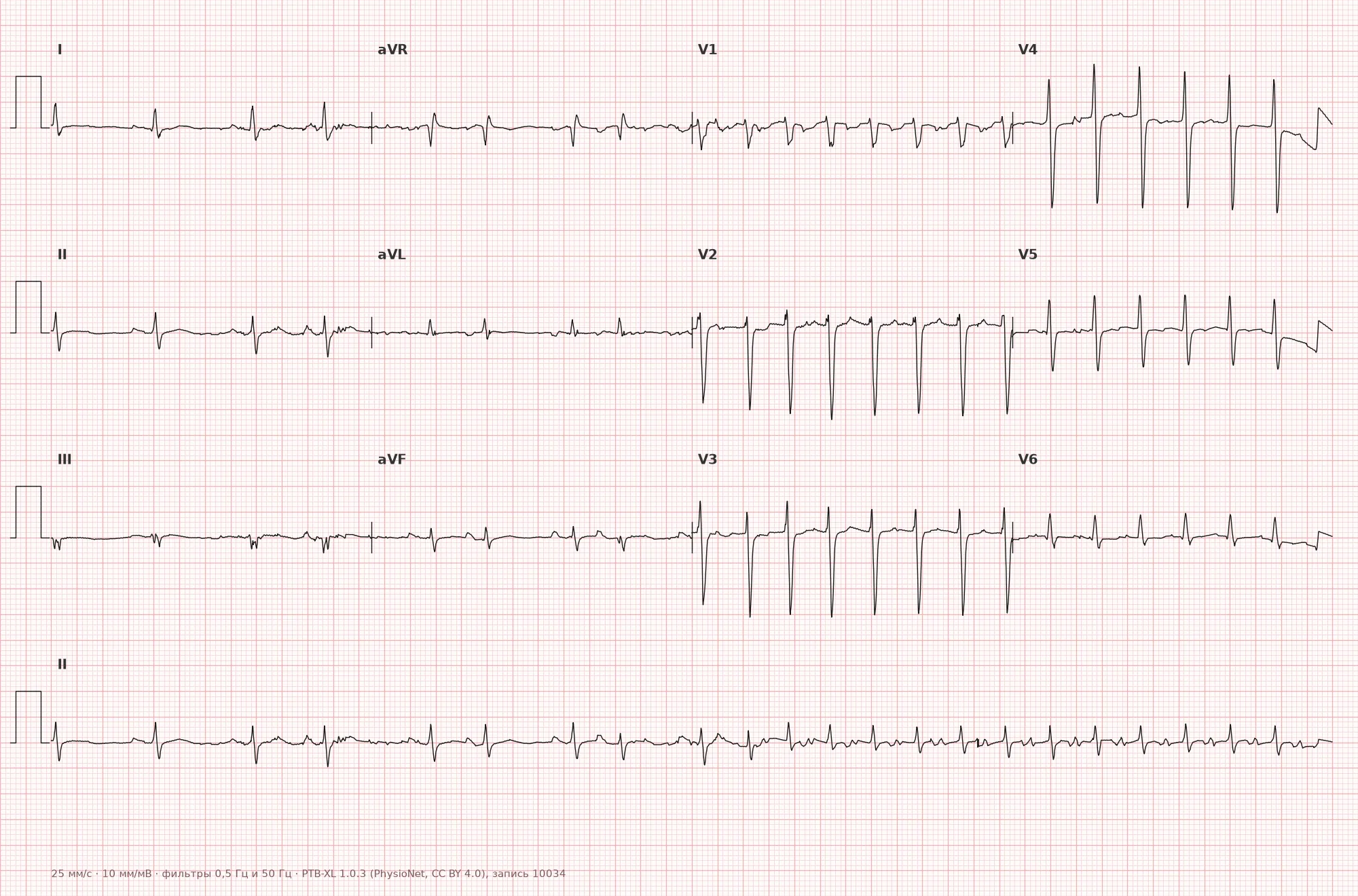 Supraventricular tachycardia on ECG — Example 1, 12 leads