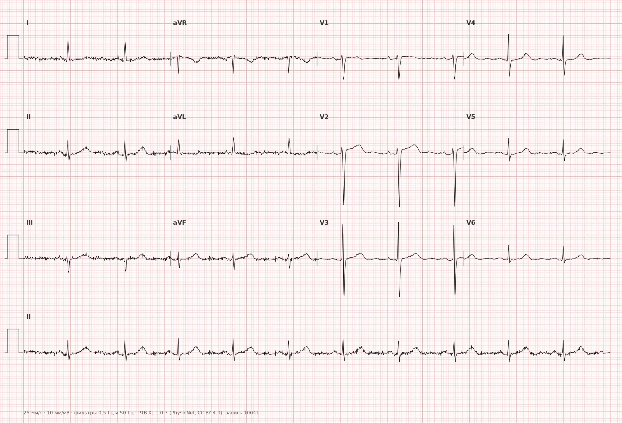 ST-segment elevation on ECG — Example 1, 12 leads