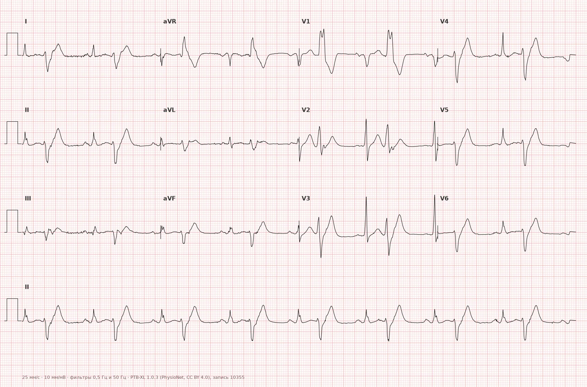 Bigeminy on ECG — Example 1, 12-lead