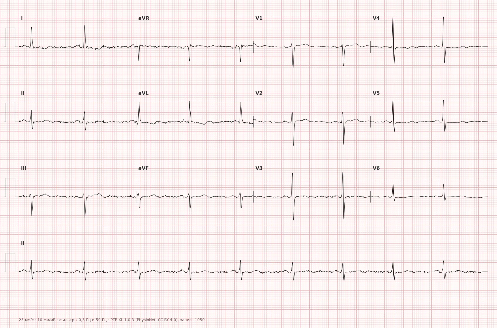 Myocardial ischemia on ECG — Example 1, 12-lead