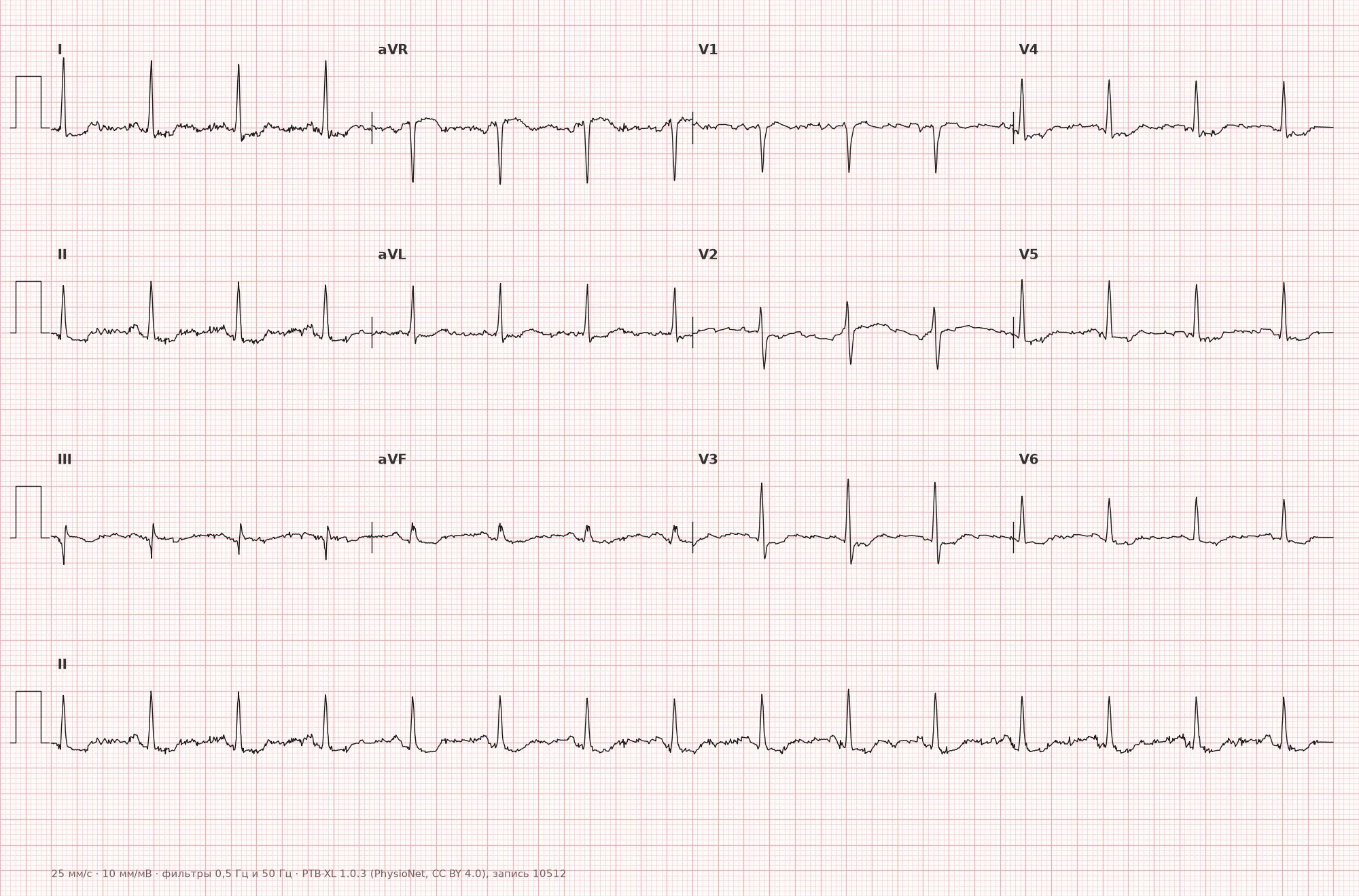 Digoxin effect on the ECG — Example 1, 12-lead ECG