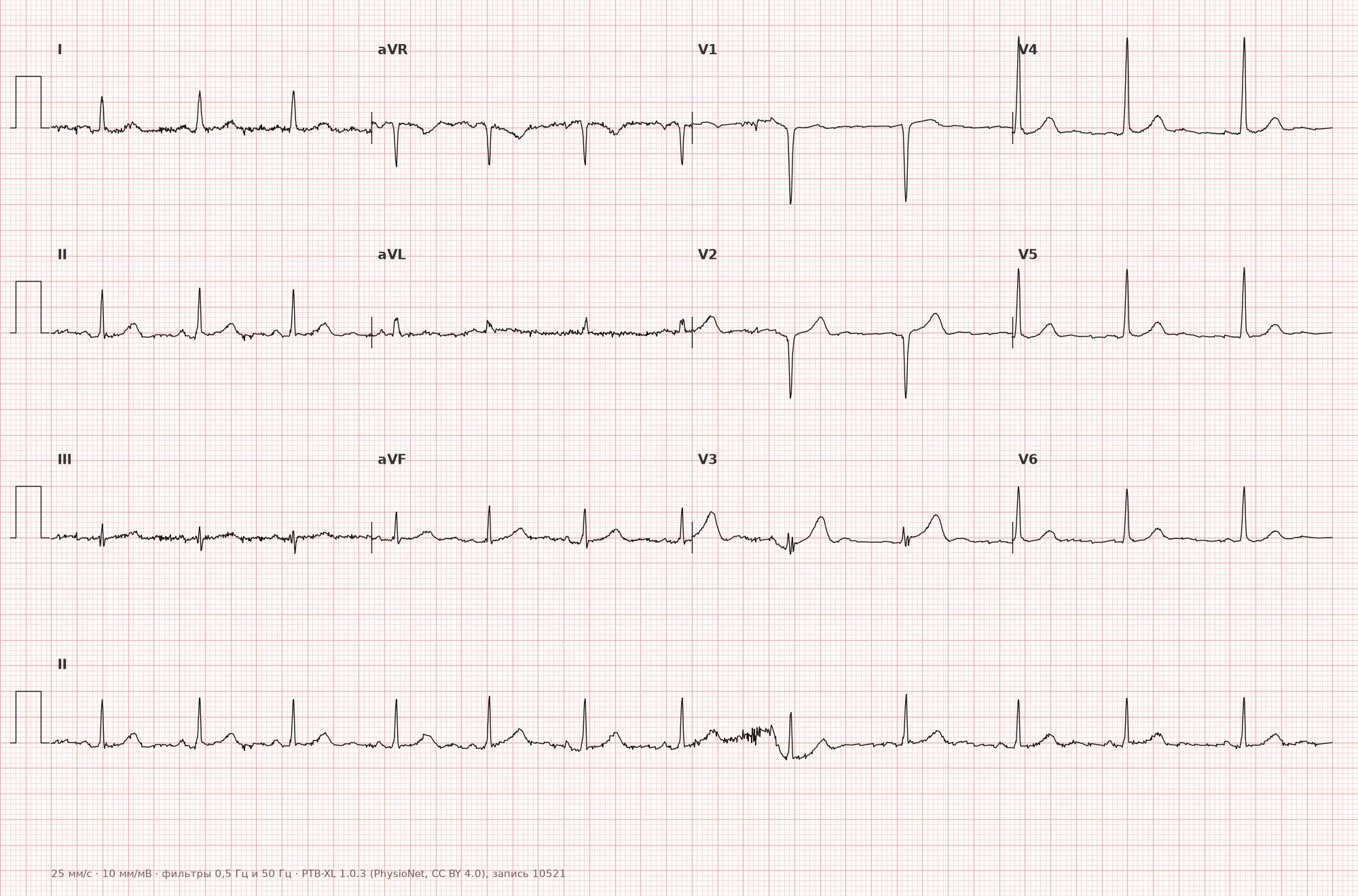 Anteroseptal myocardial infarction on ECG — example 1, 12 leads