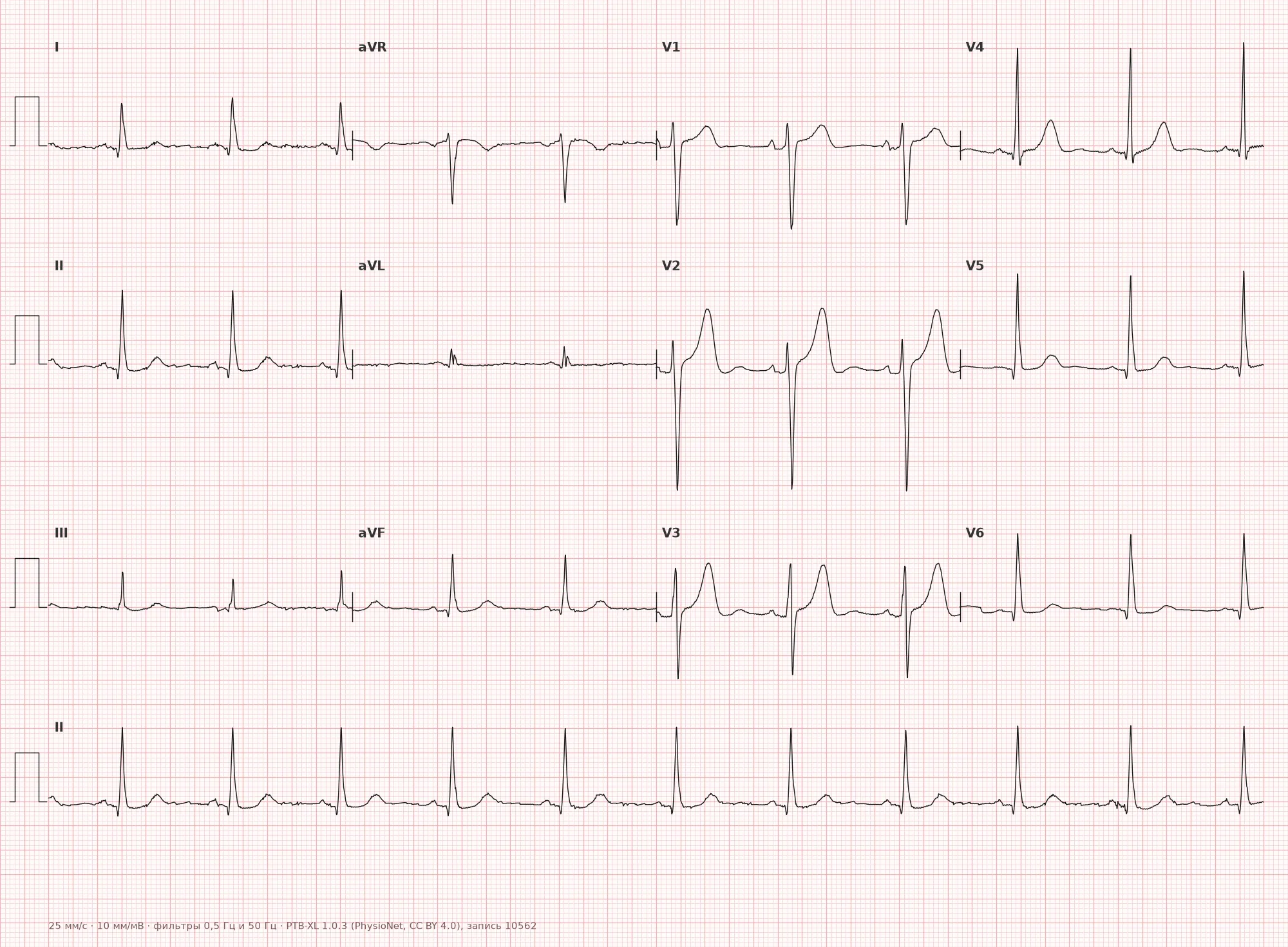 Left ventricular hypertrophy on ECG — Example 1, 12-lead