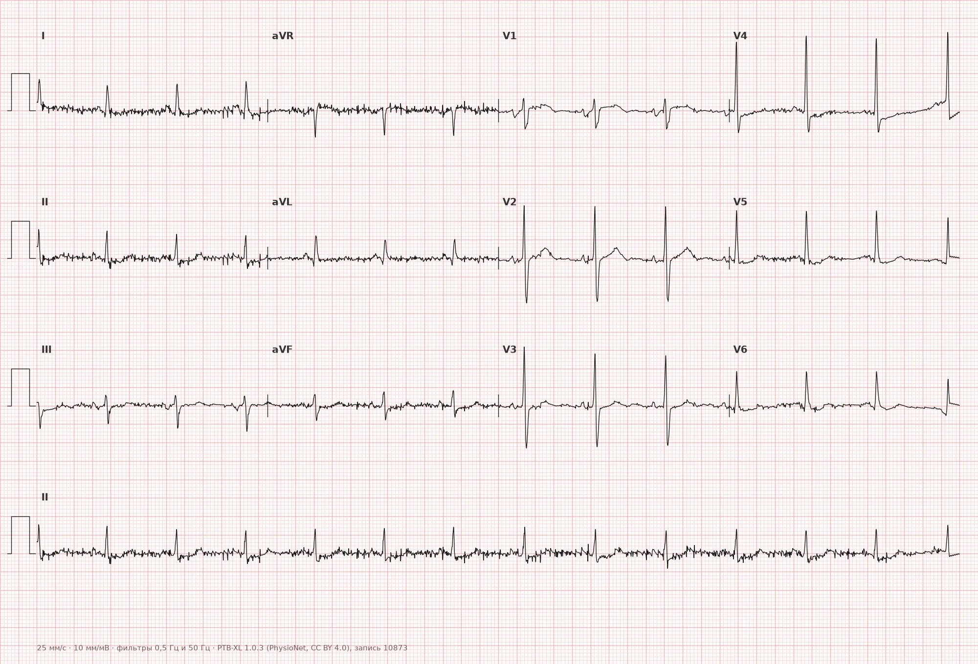 Lateral myocardial infarction on ECG — Example 1, 12-lead