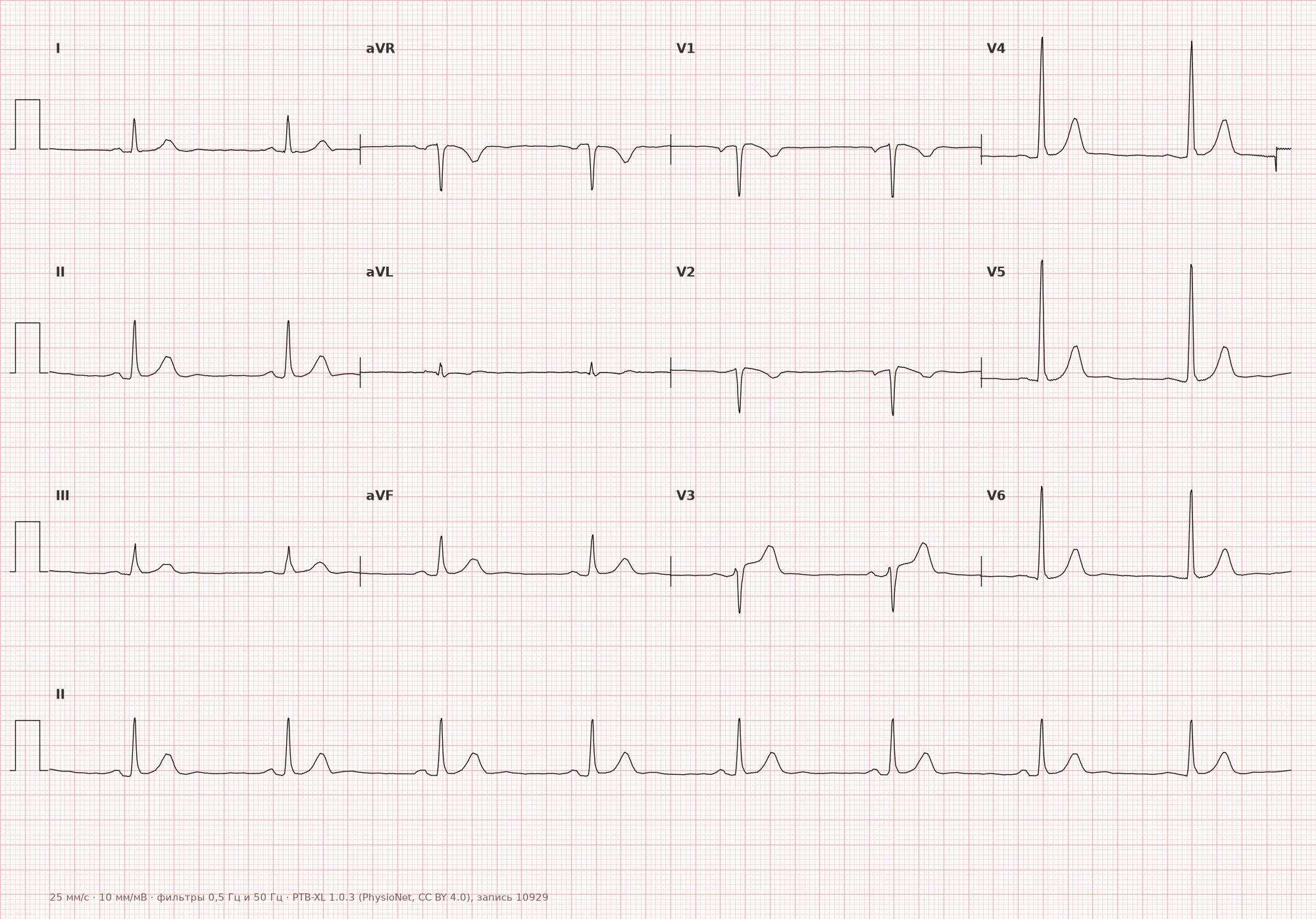 Sinus bradycardia on ECG — Example 1, 12-lead