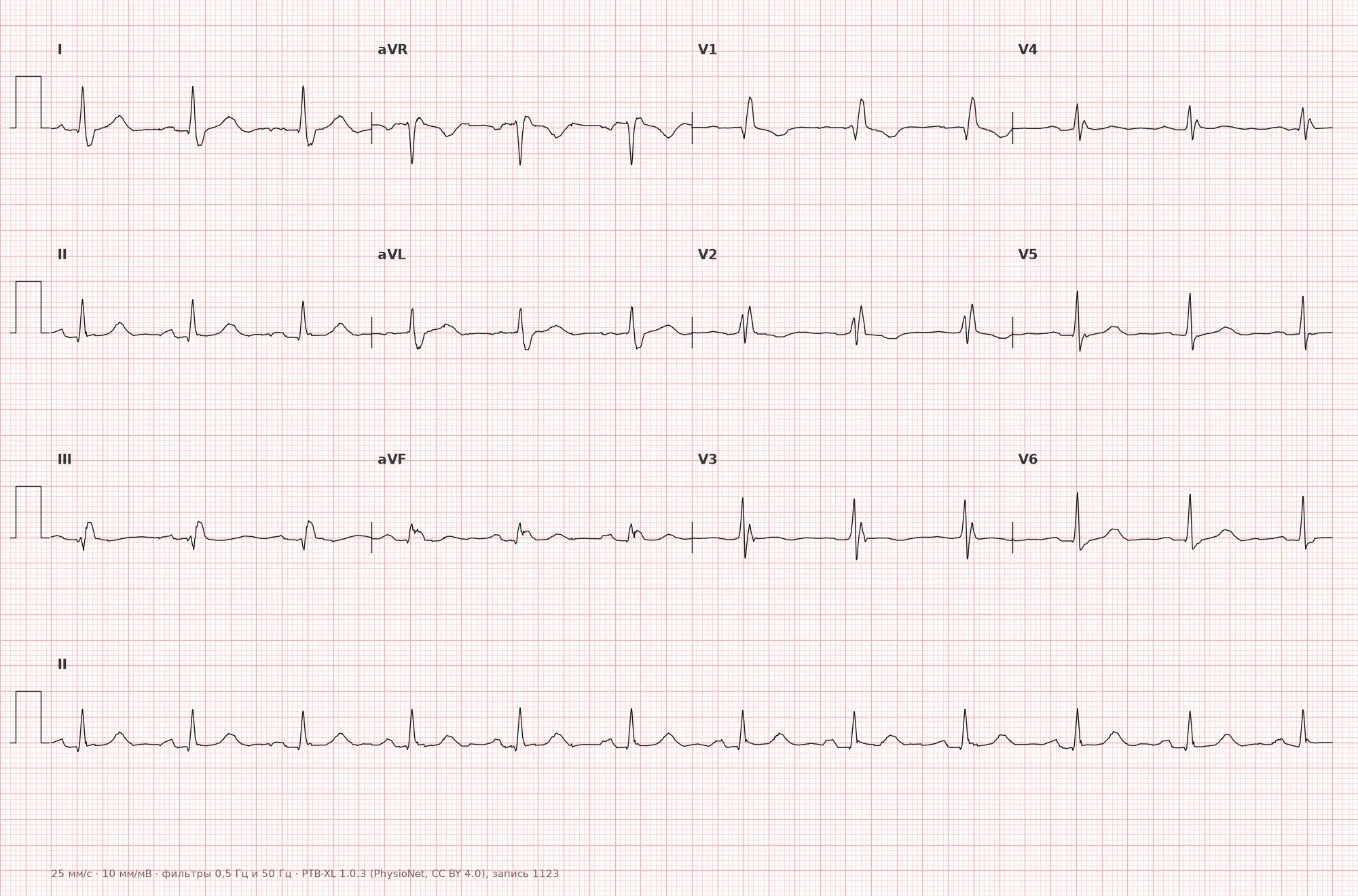 Right bundle branch block on ECG — example 1, 12 leads