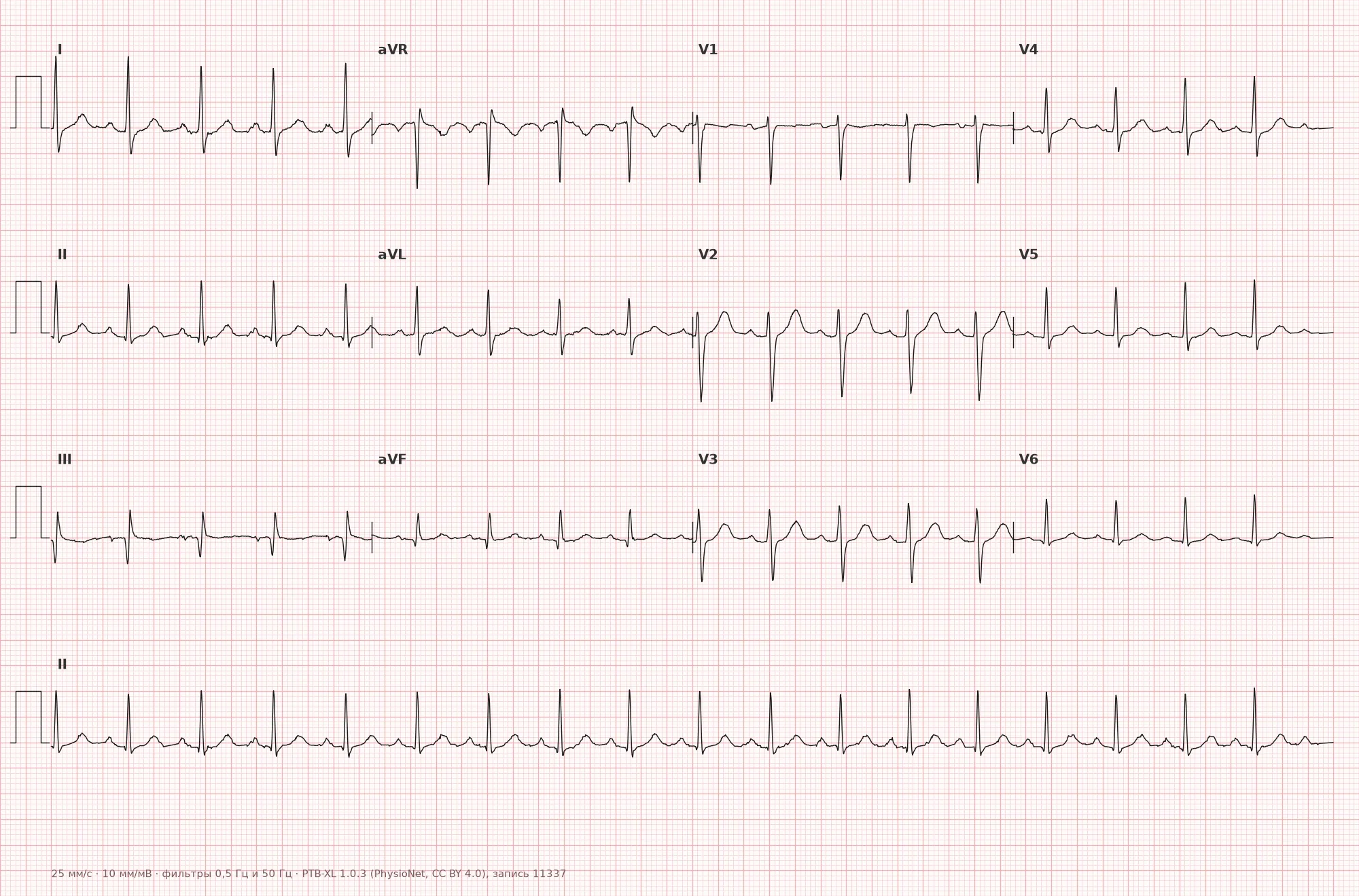 Sinus tachycardia on ECG — Example 1, 12-lead