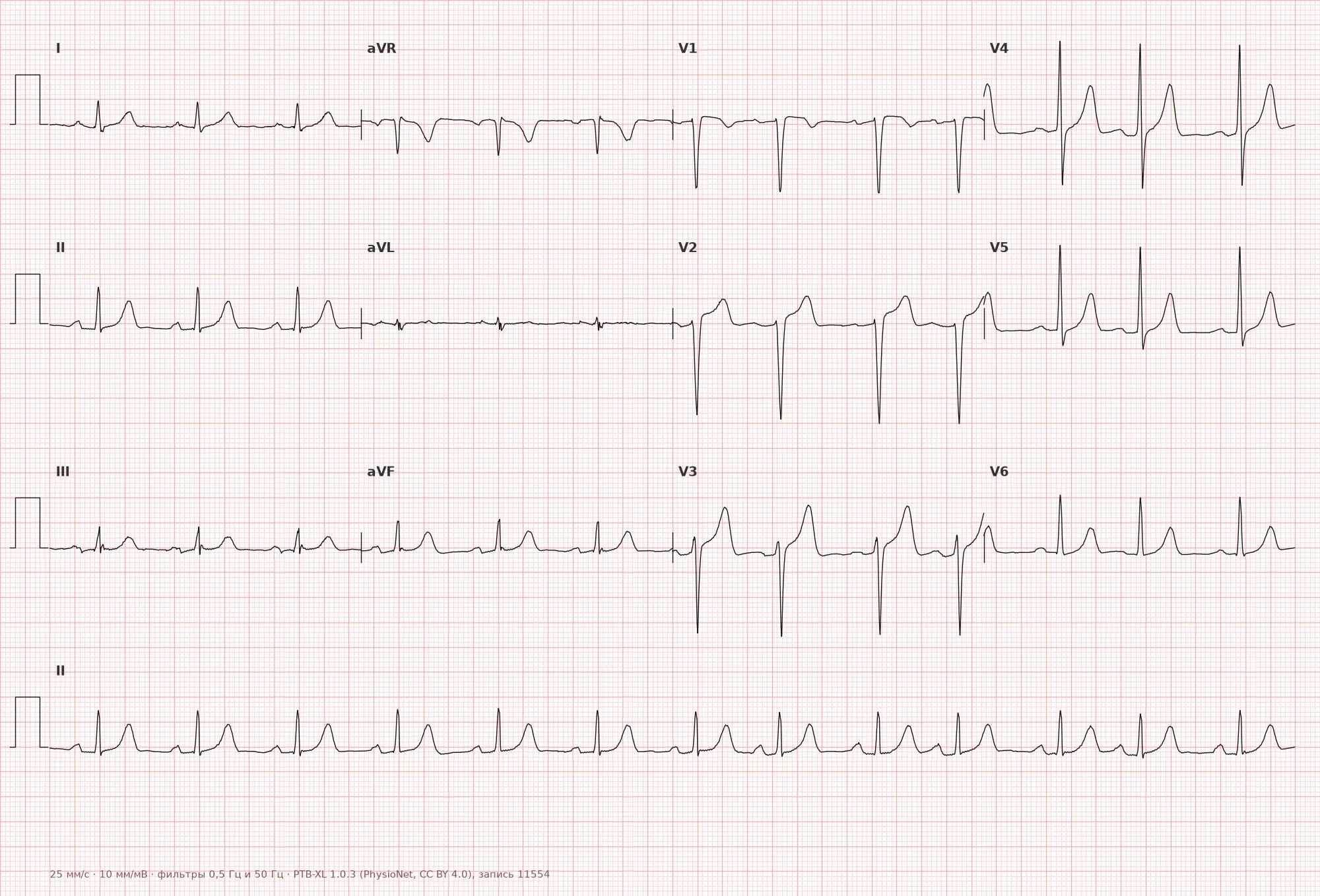 Sinus arrhythmia on ECG — Example 1, 12-lead