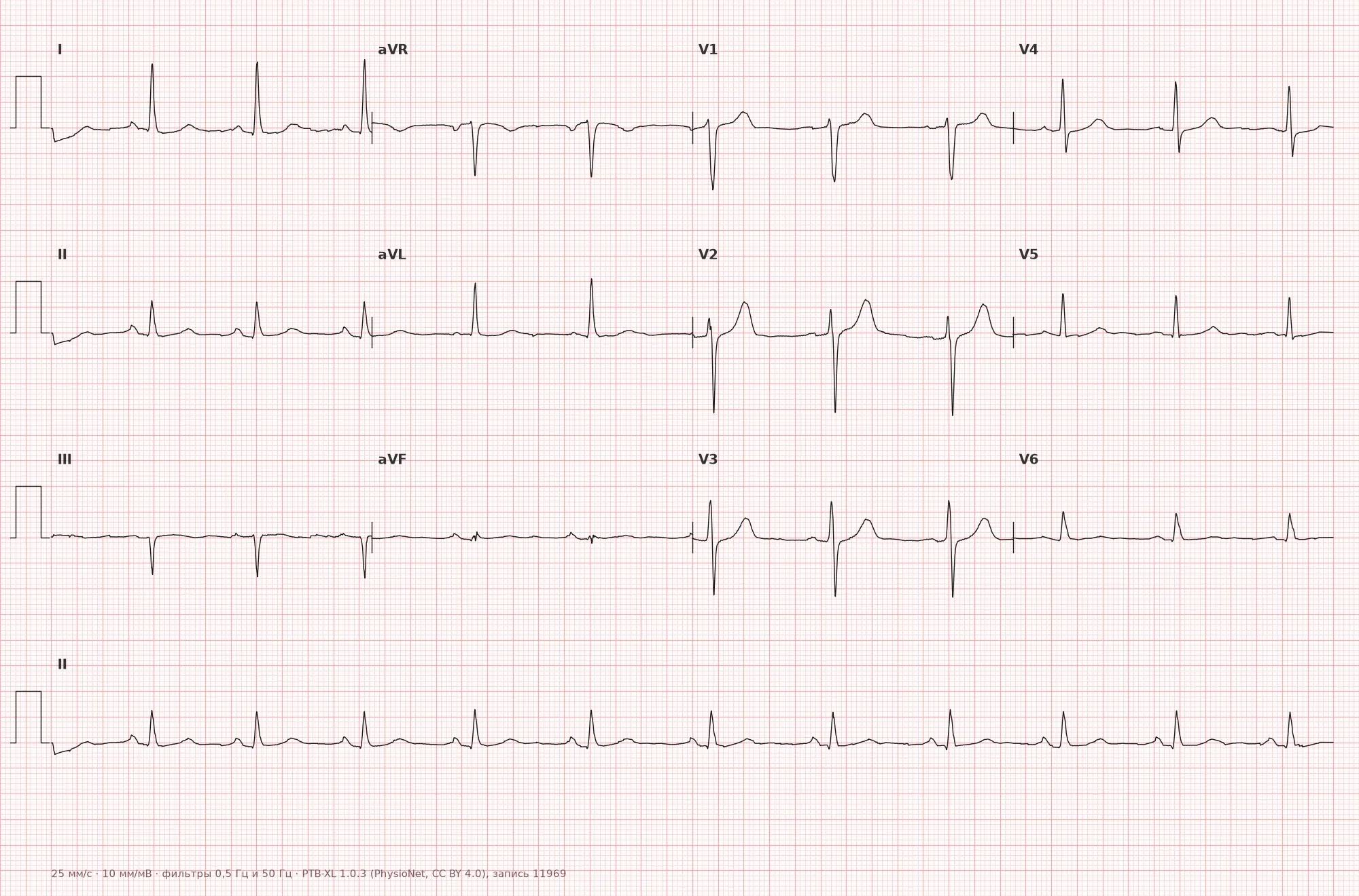 Flattened T wave on ECG — Example 1, 12-lead