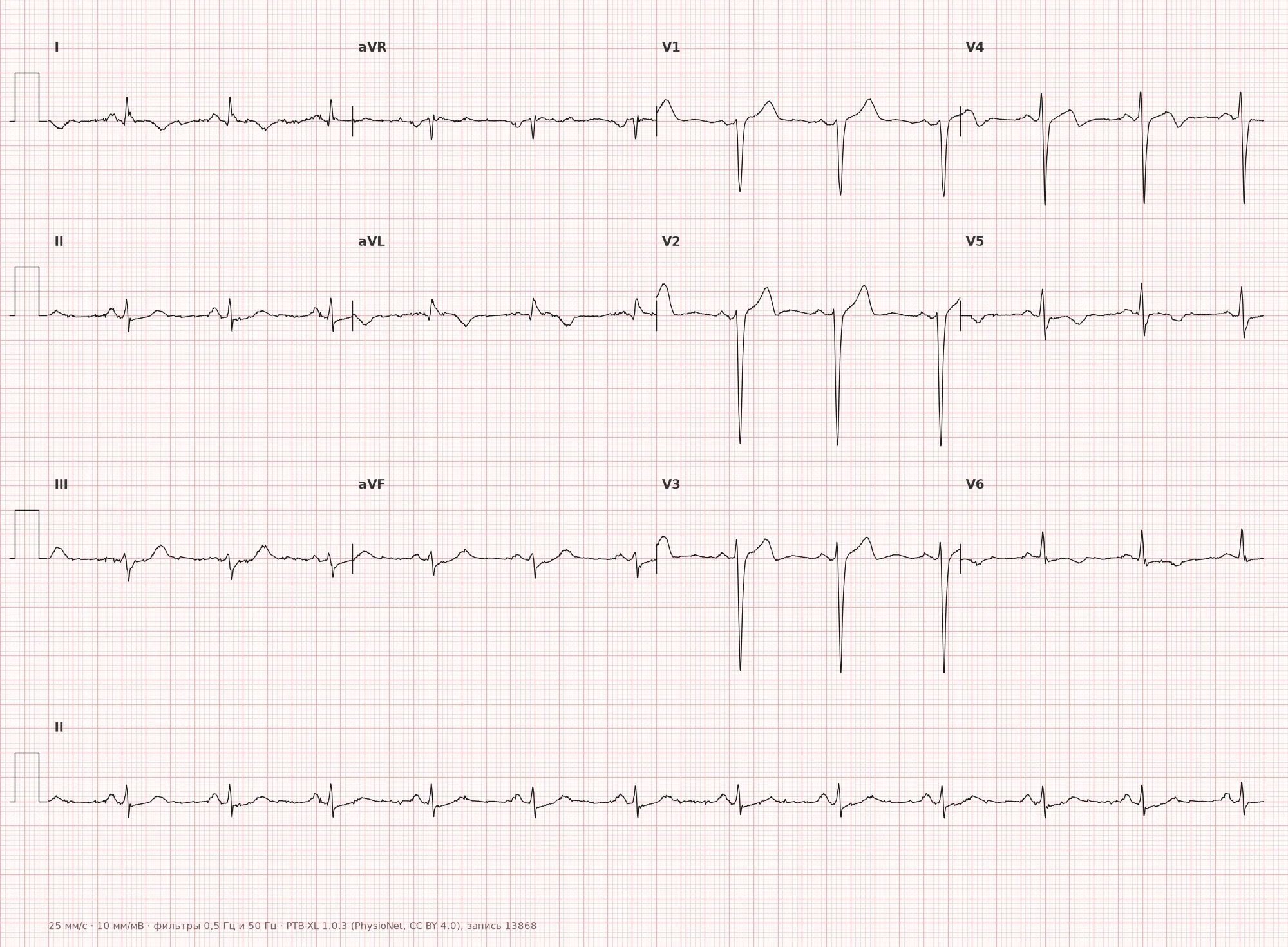 Anterolateral infarction on ECG — Example 1, 12 leads