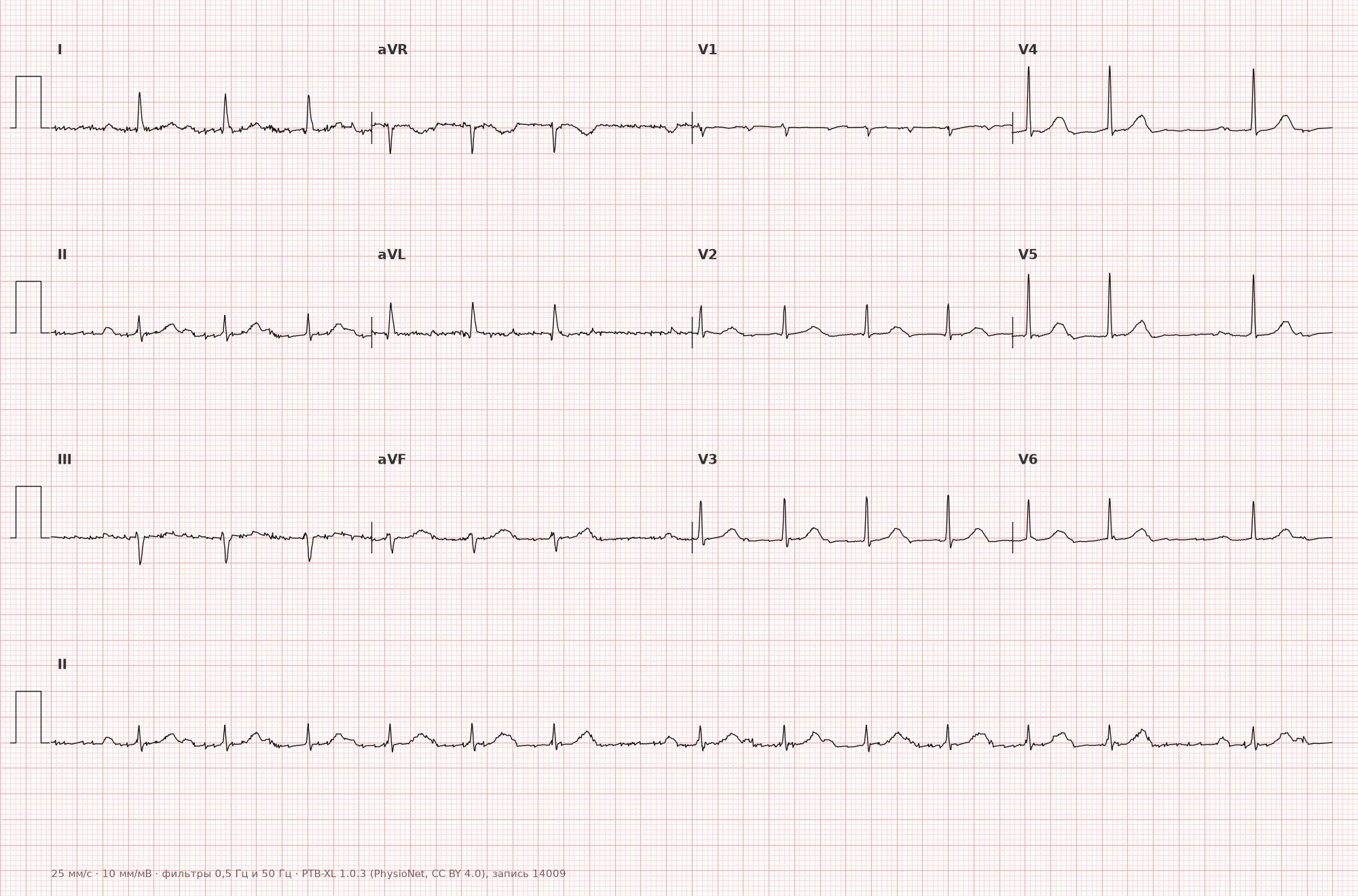 Second-degree AV block on ECG — example 1, 12 leads