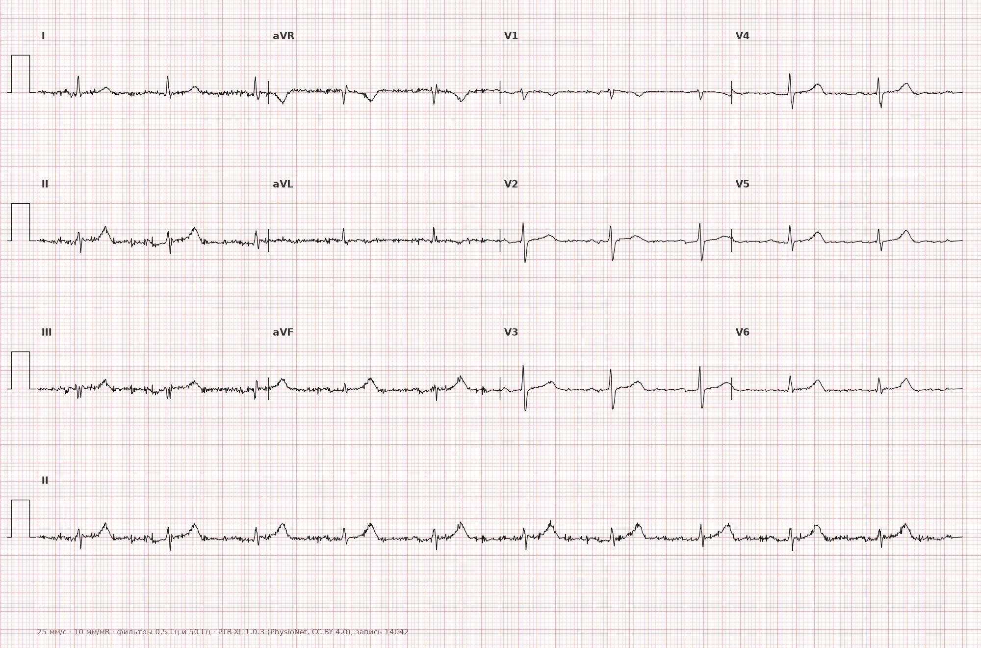 Low QRS voltage on ECG — Example 1, 12-lead