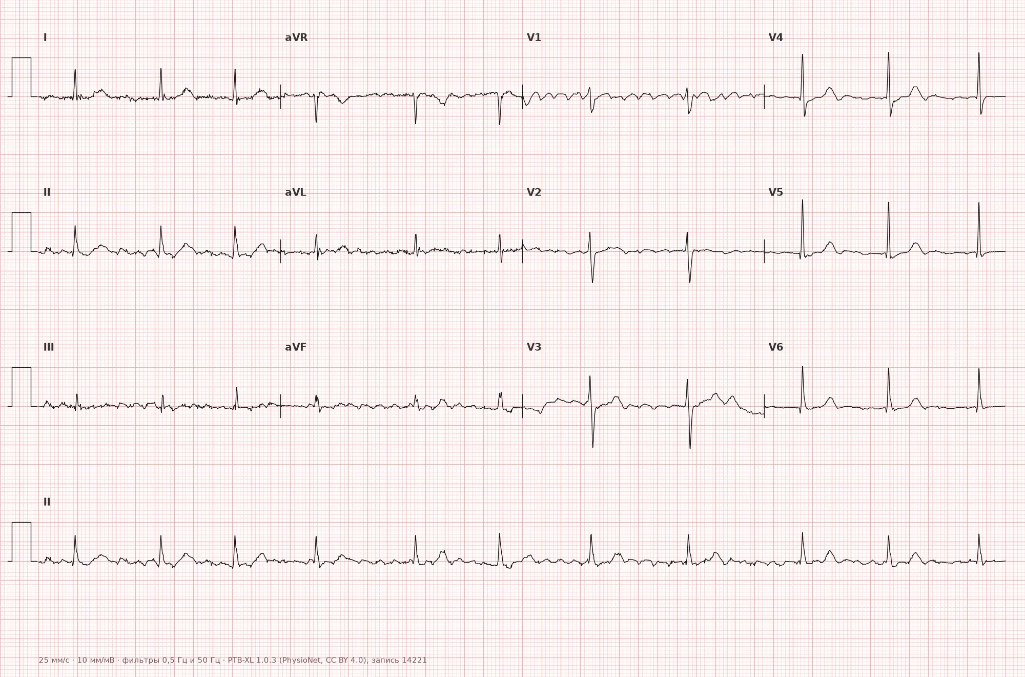 Coarse atrial fibrillation on ECG — Example 1, 12 leads