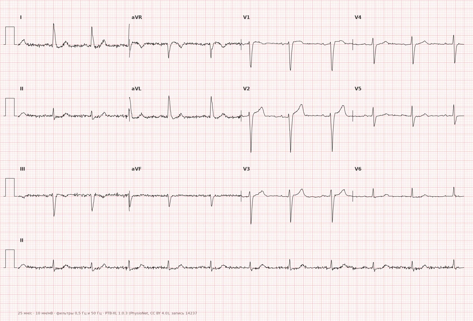 Incomplete left bundle branch block on ECG — Example 1, 12 leads