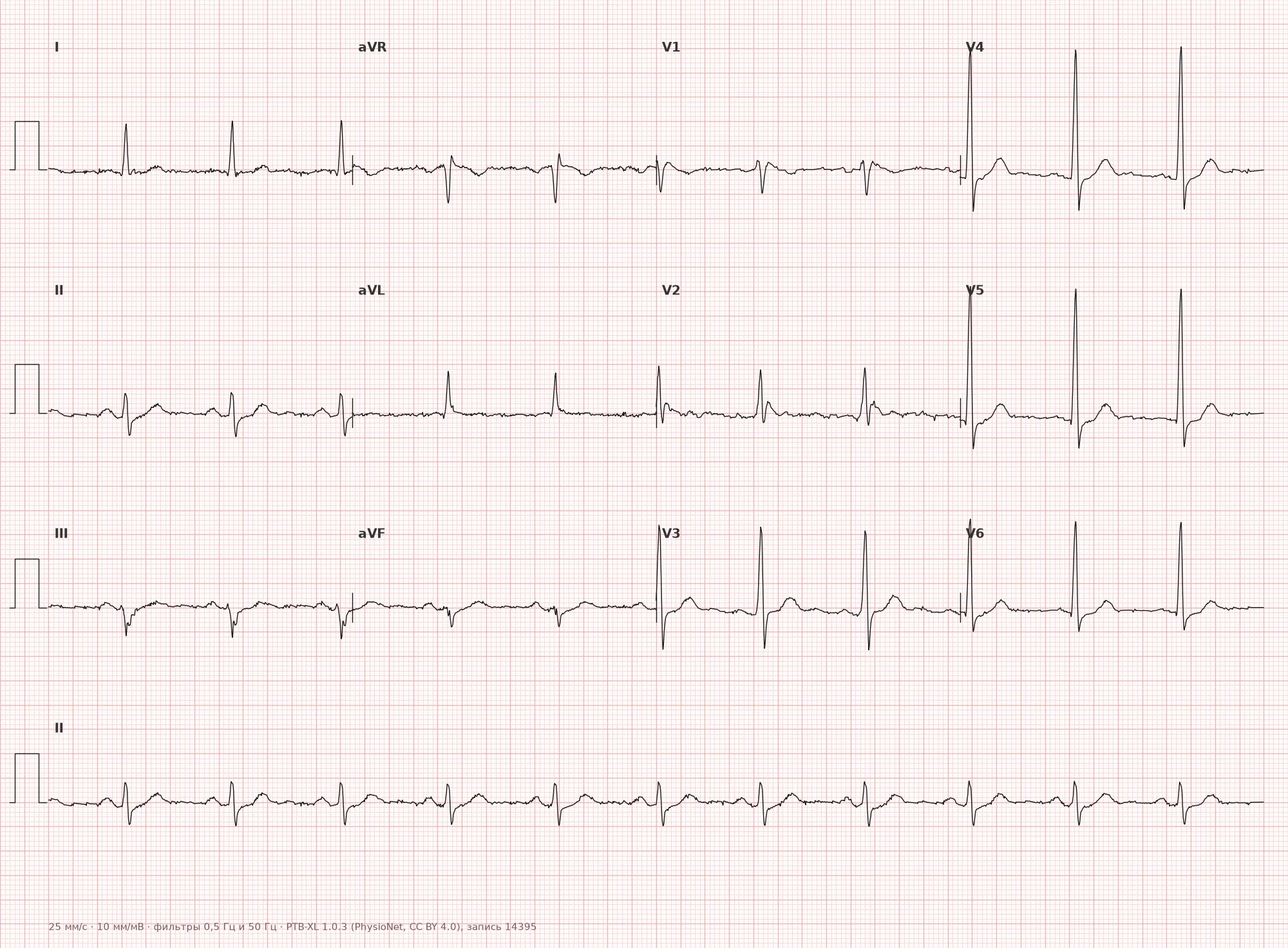 Incomplete right bundle branch block on ECG — Example 1, 12-lead