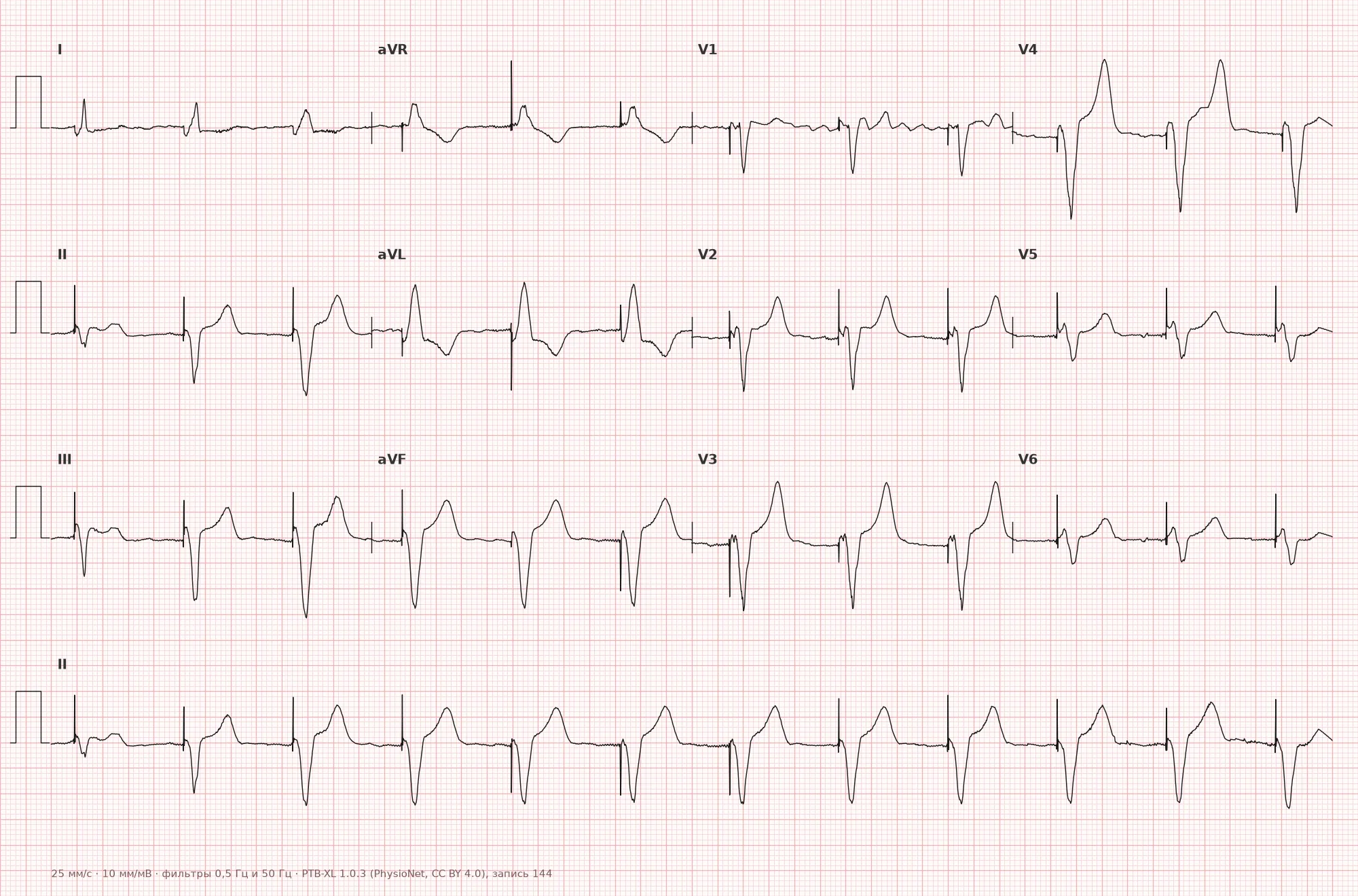 ECG with pacemaker — example 1, 12 leads