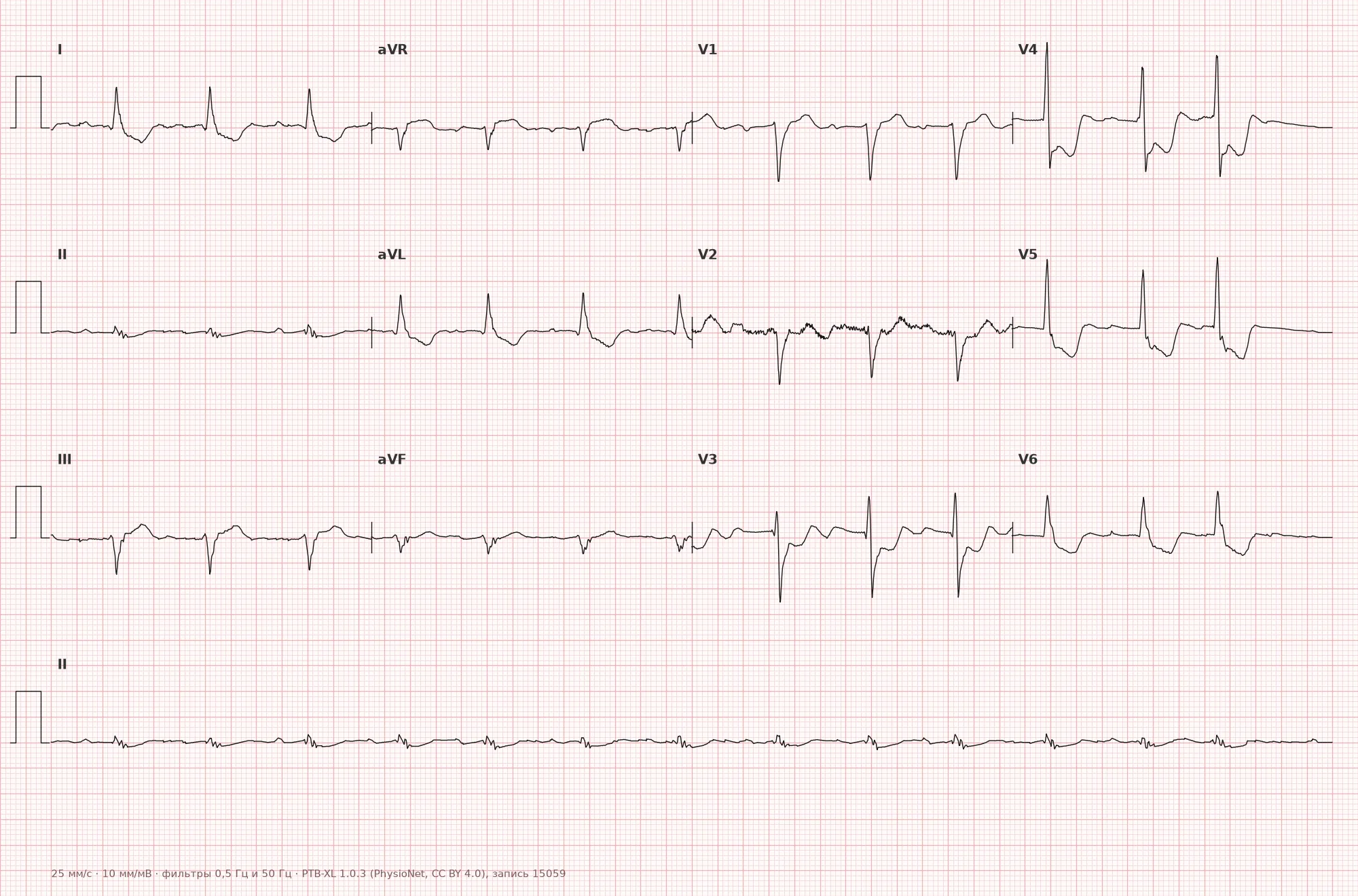 Posterior myocardial infarction on ECG — Example 1, 12 leads