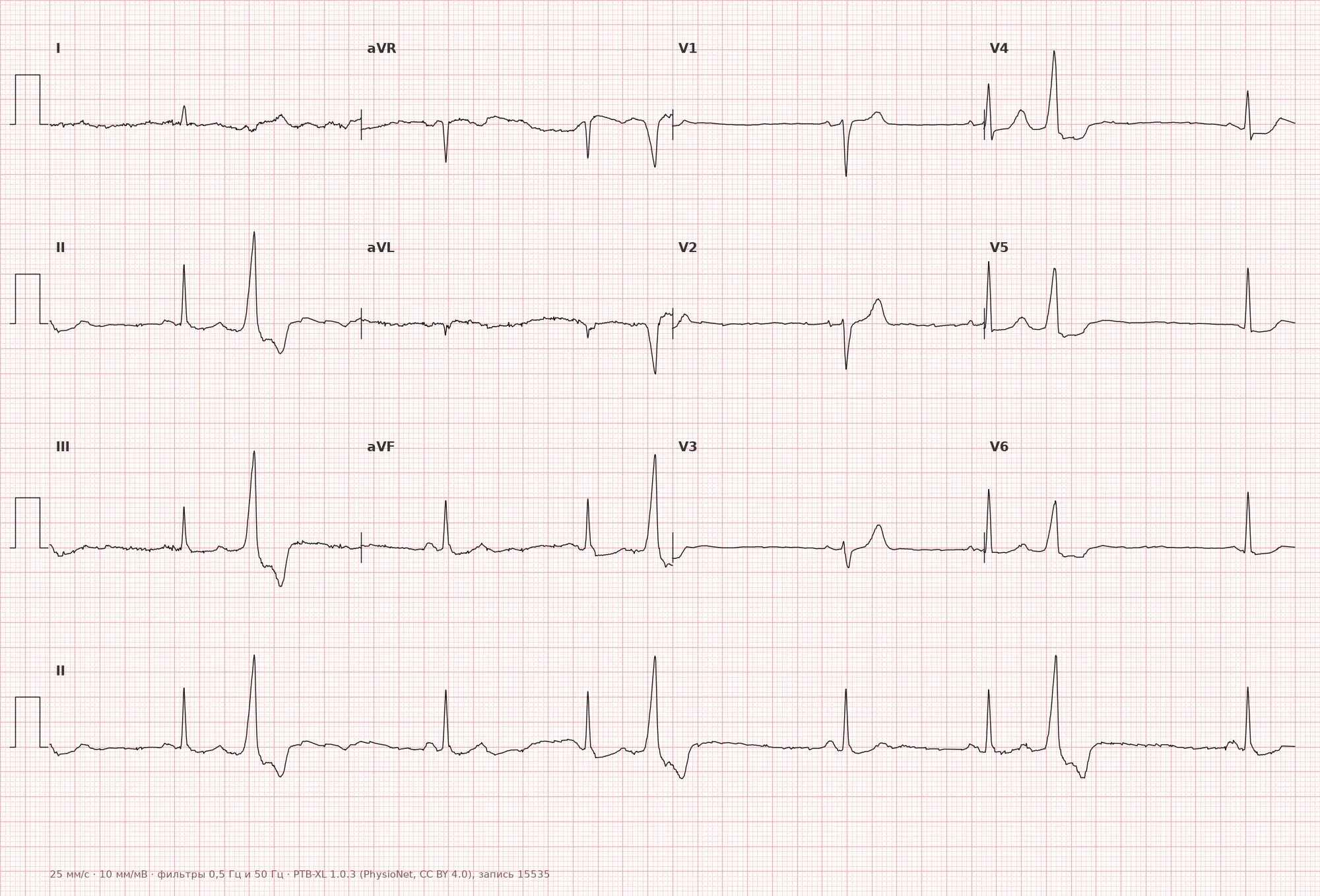 Trigeminy on ECG — Example 1, 12-lead