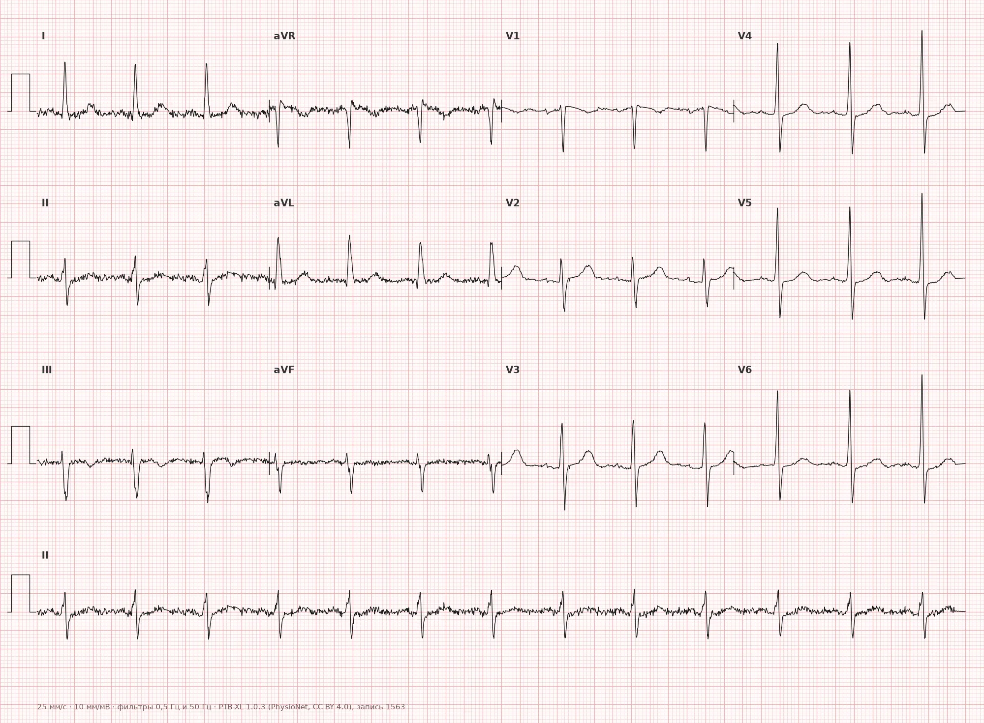 Left Anterior Fascicular Block on ECG — Example 1, 12-lead
