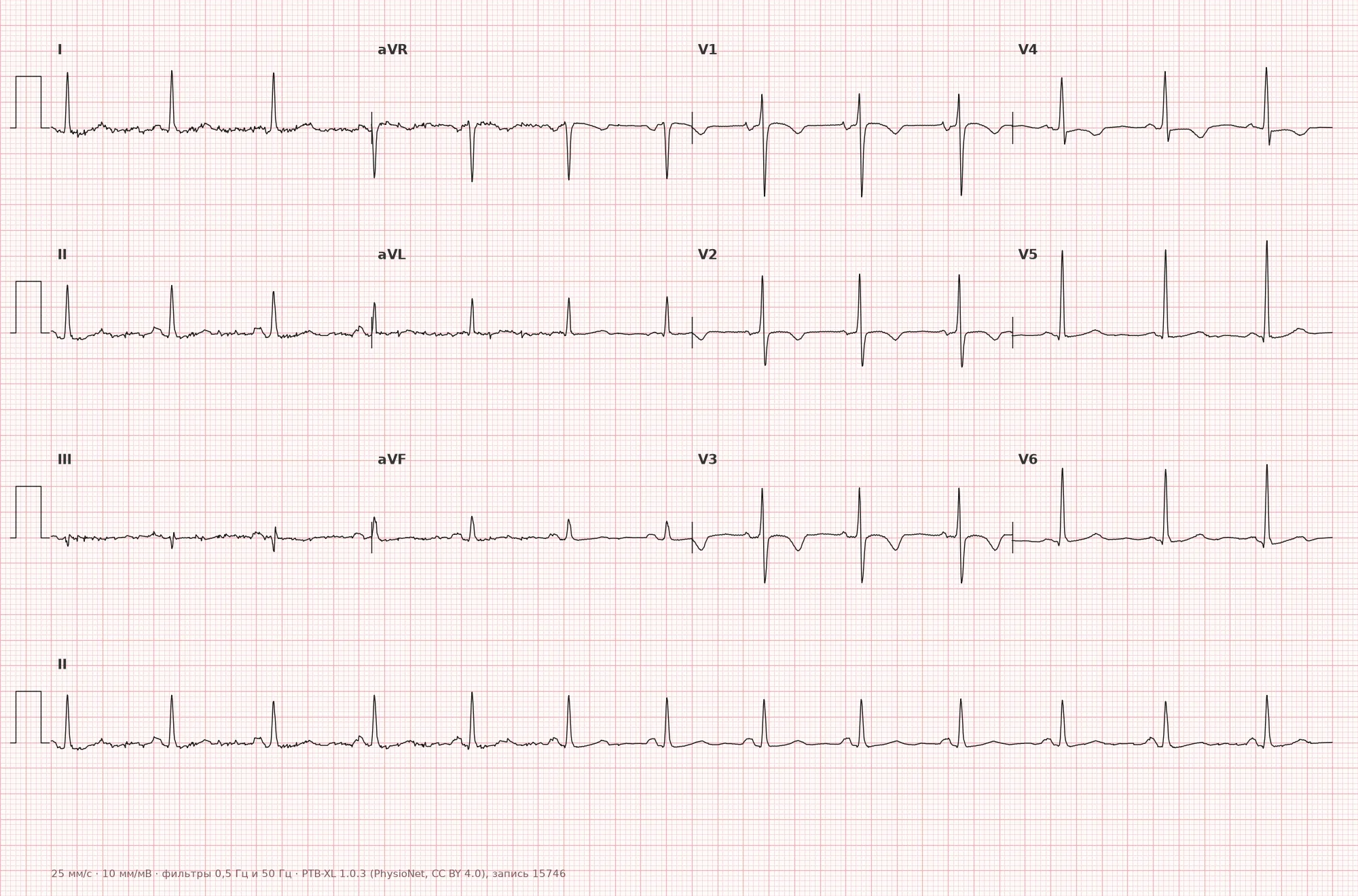 Negative T wave on ECG — Example 1, 12-lead