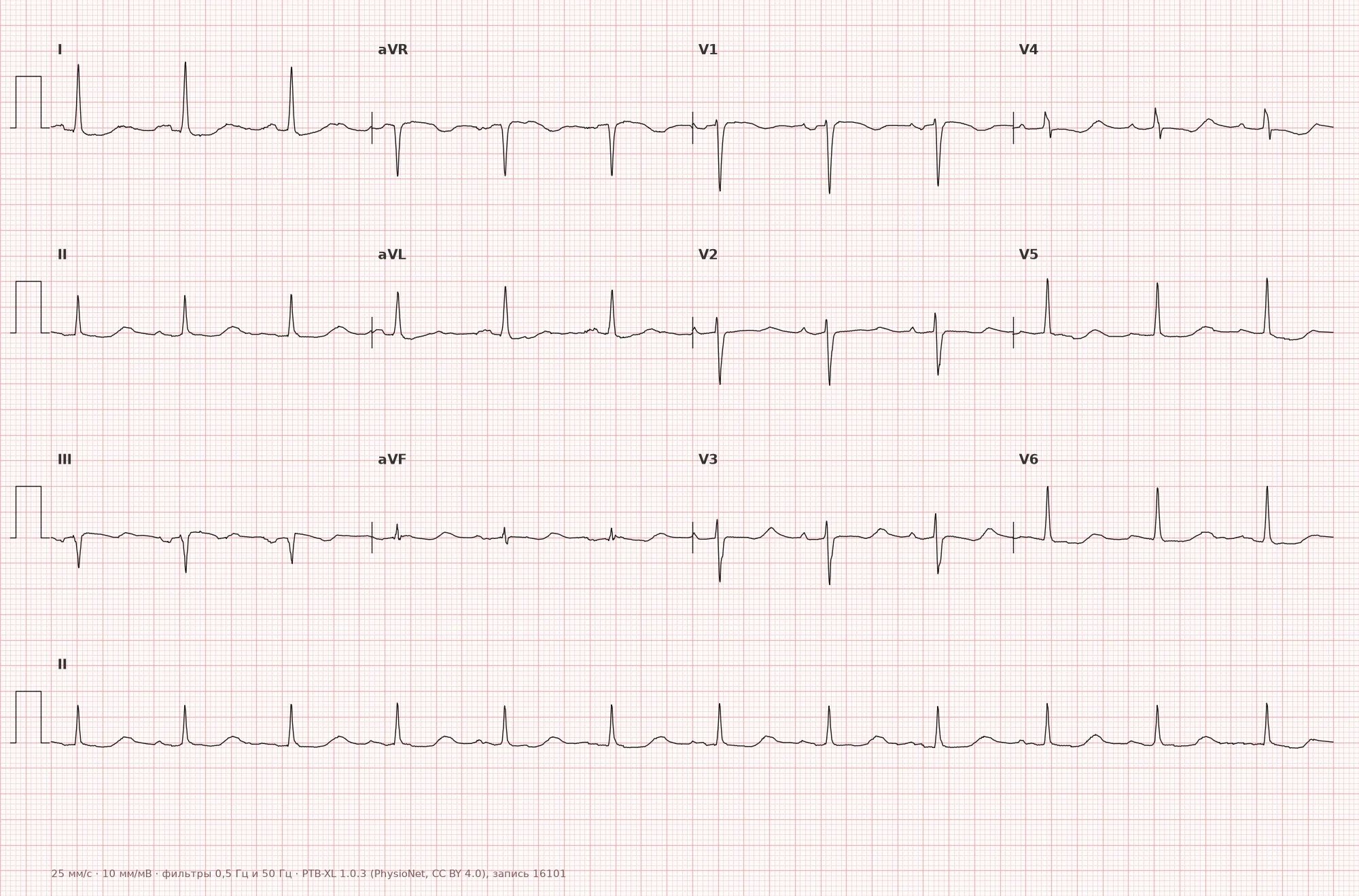 Electrolyte Disturbances on the ECG — Example 1, 12 leads