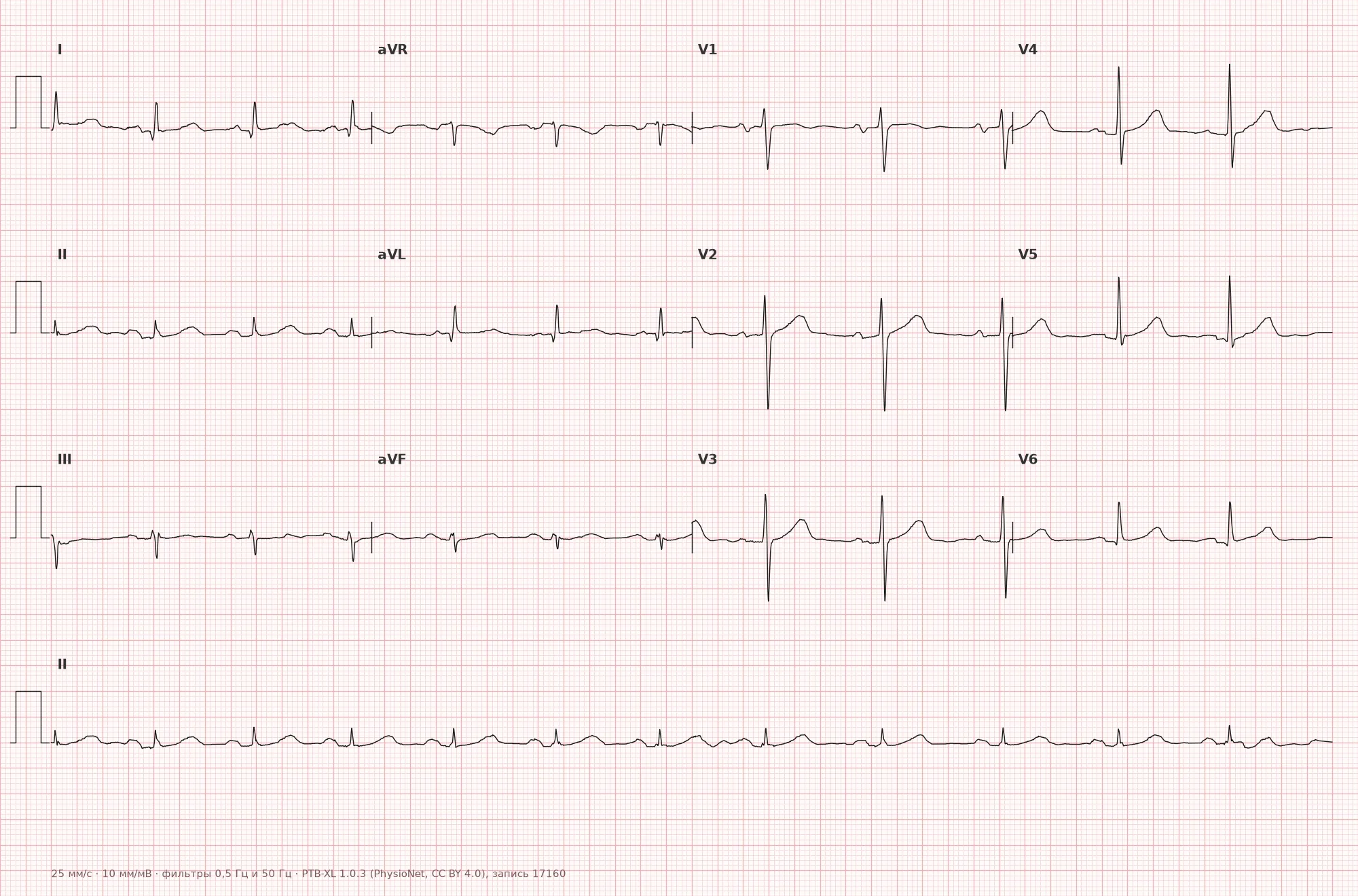 Left atrial enlargement on ECG — example 1, 12 leads