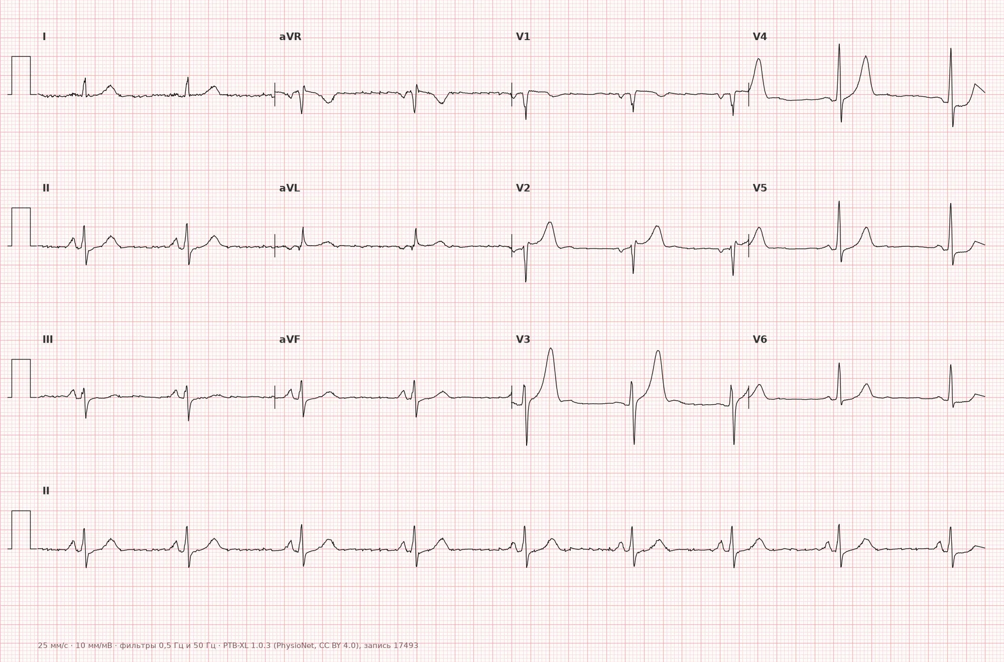 Anterior myocardial infarction on ECG — Example 1, 12-lead