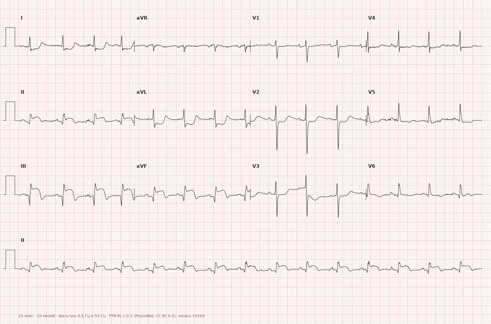 Inferoposterior myocardial infarction on ECG — example 1, 12-lead