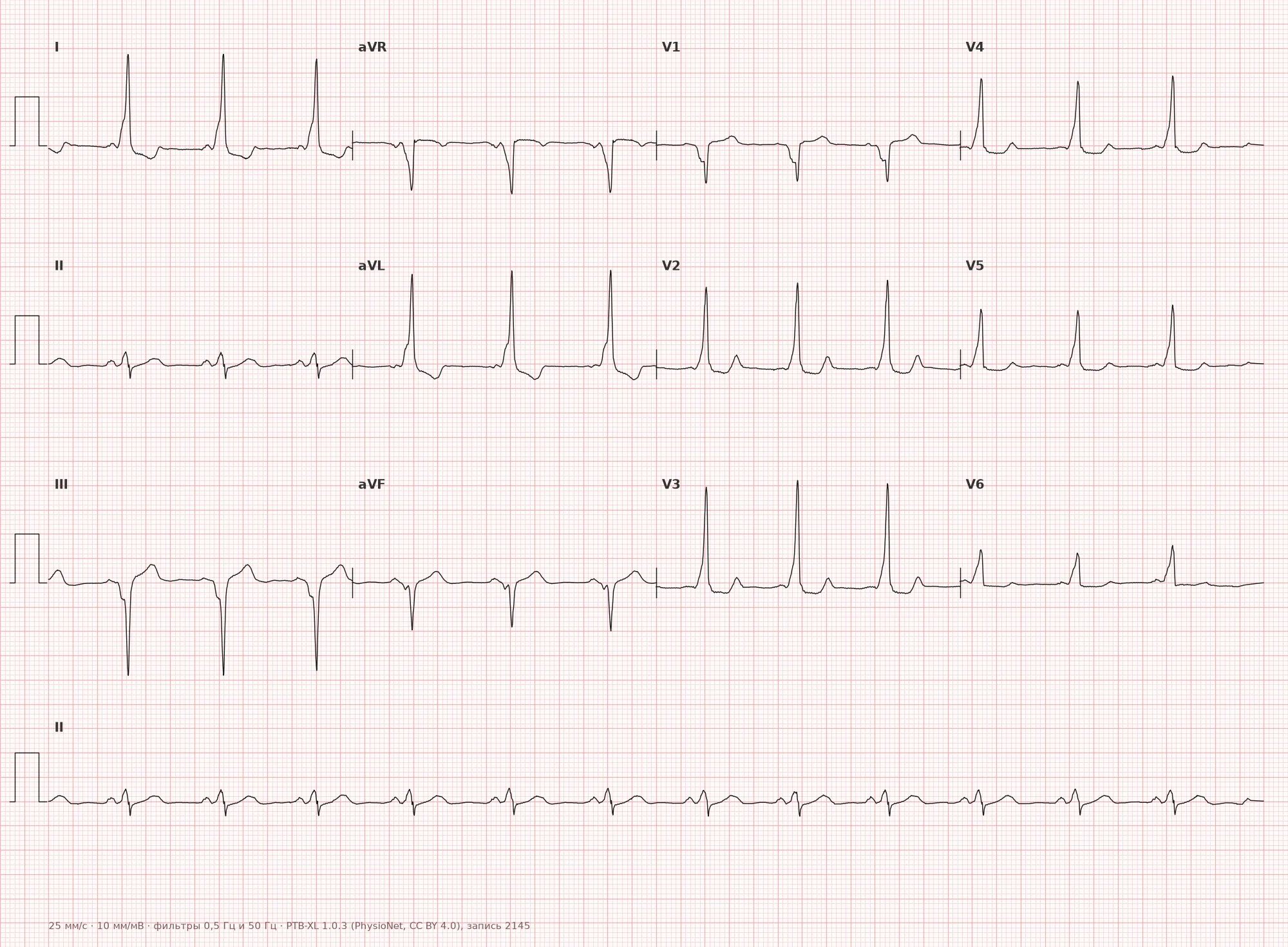 Delta wave on ECG — Example 1, 12 leads
