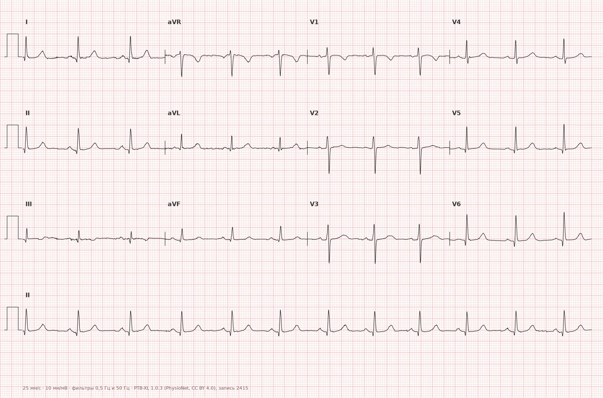 Interventricular septal hypertrophy on ECG — Example 1, 12-lead