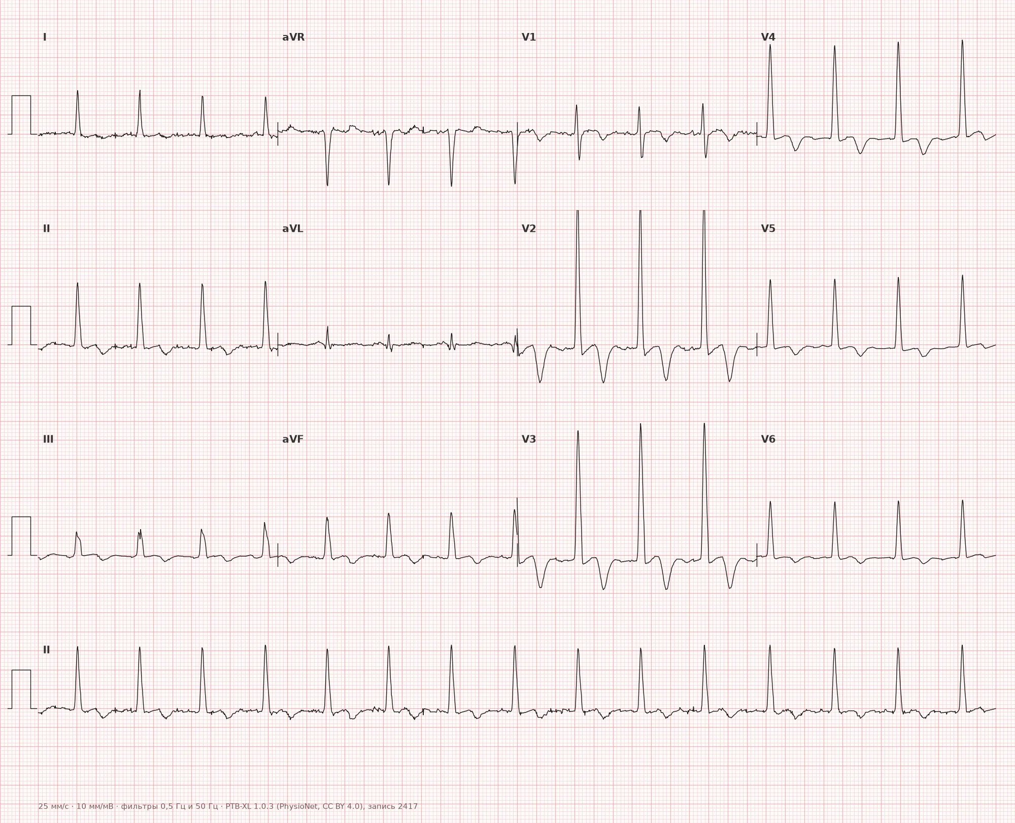 Right Ventricular Hypertrophy on ECG — Example 1, 12-lead