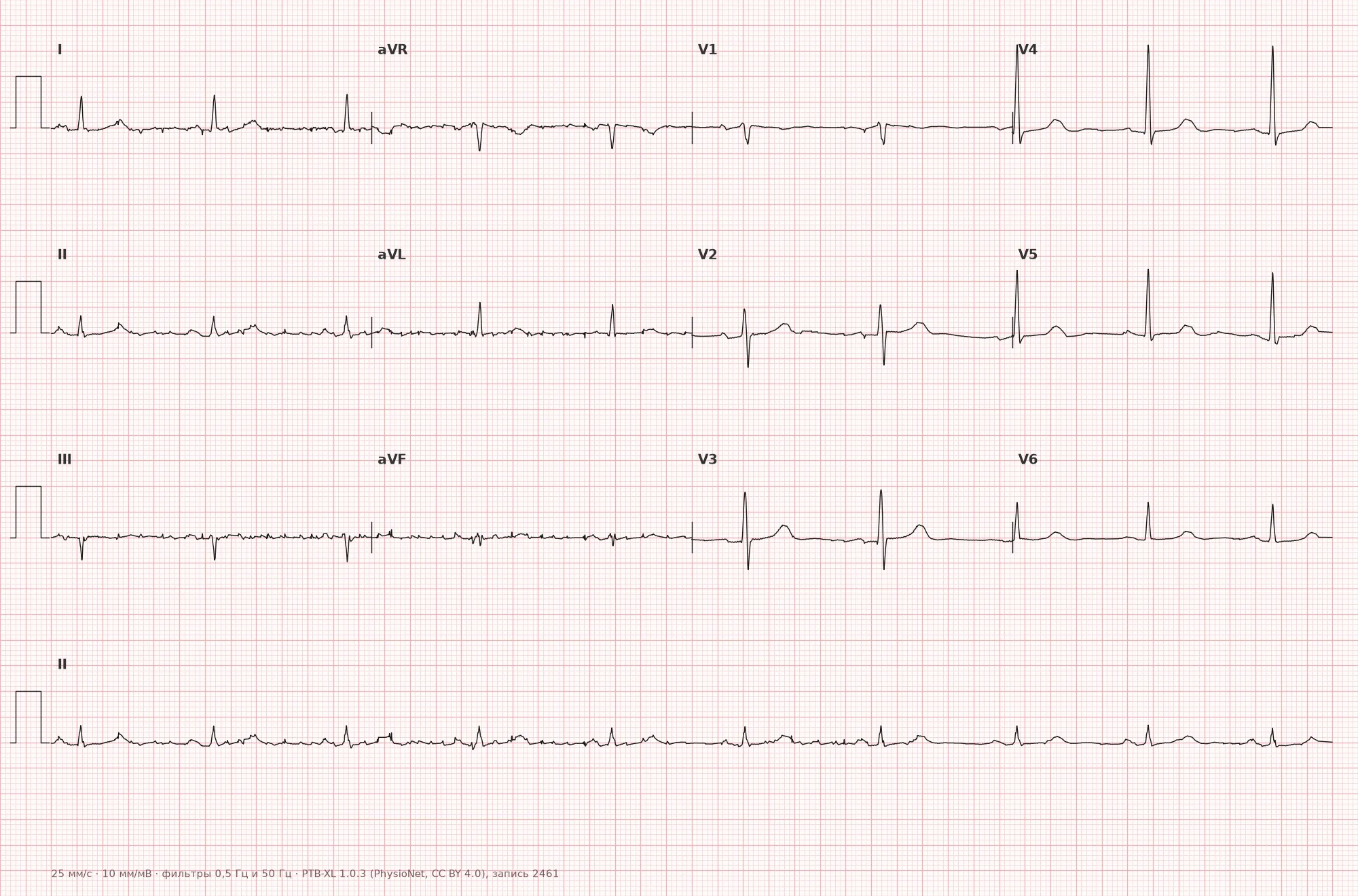 Normal ECG on 12-lead tracing — Example 1