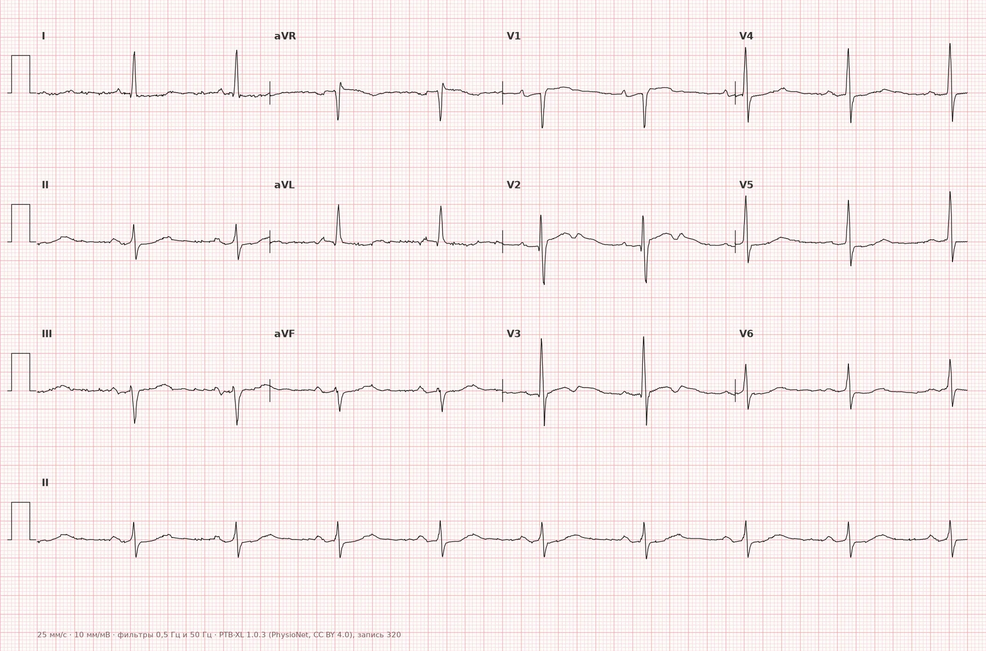 Long QT Syndrome on ECG — Example 1, 12 leads