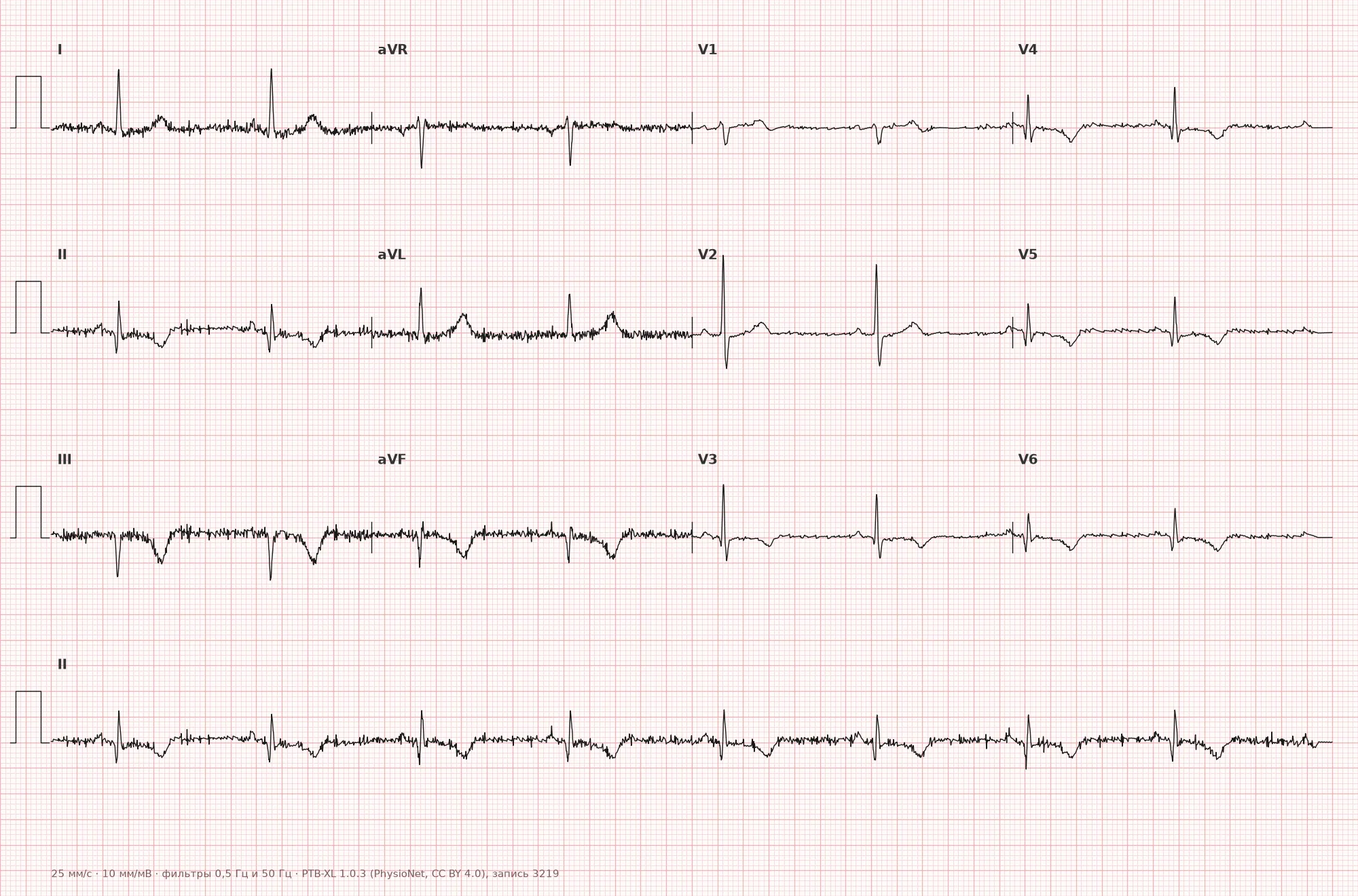 Inferolateral myocardial infarction on ECG — Example 1, 12-lead