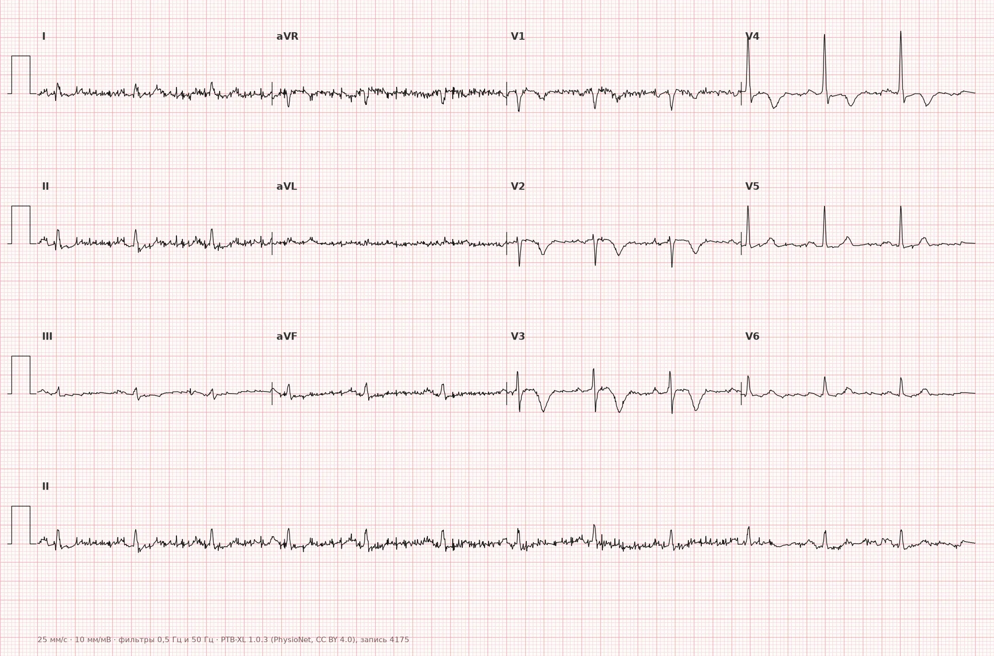 Subepicardial injury on ECG — Example 1, 12-lead