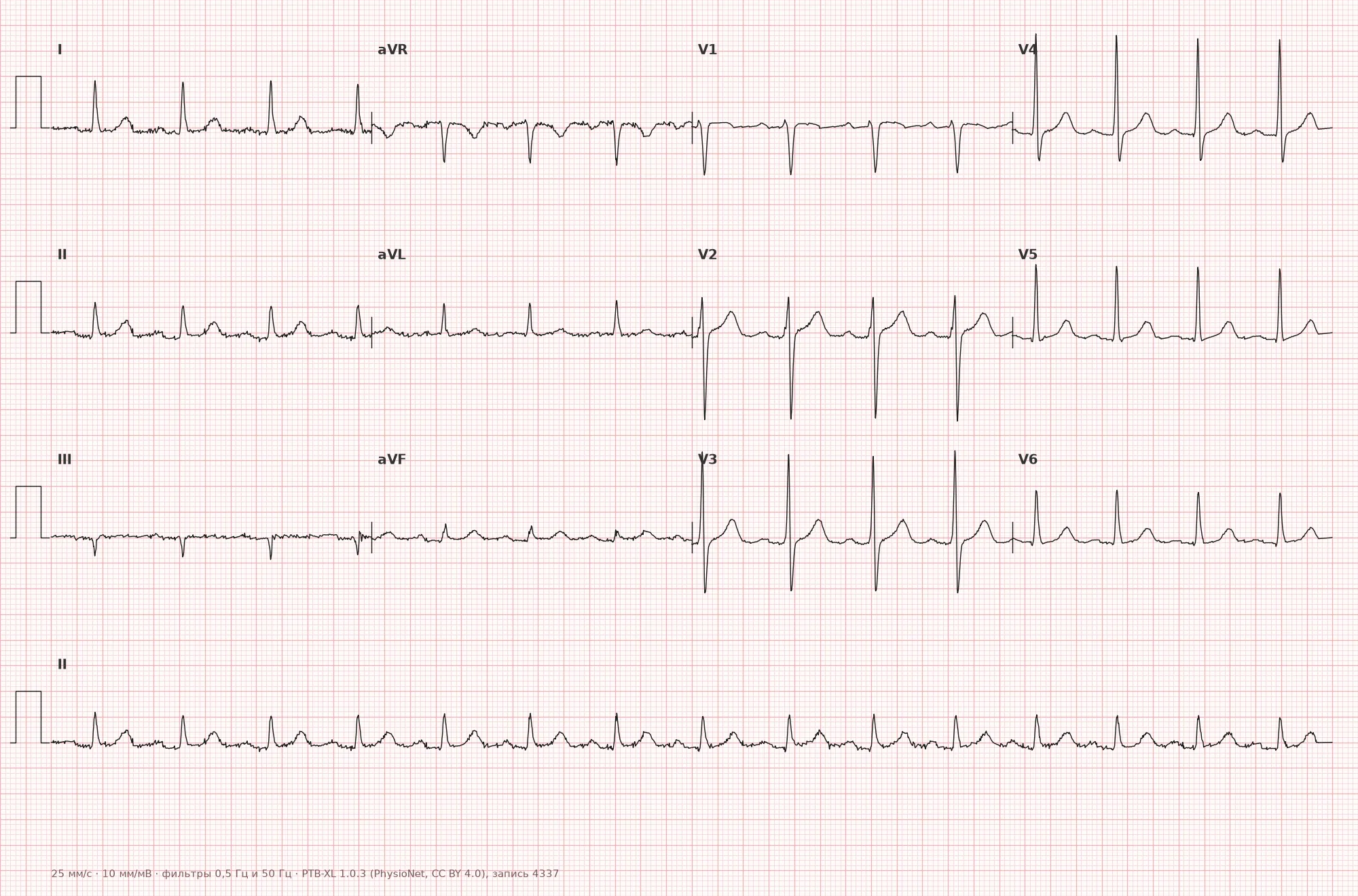 Sinus rhythm on ECG — Example 1, 12-lead