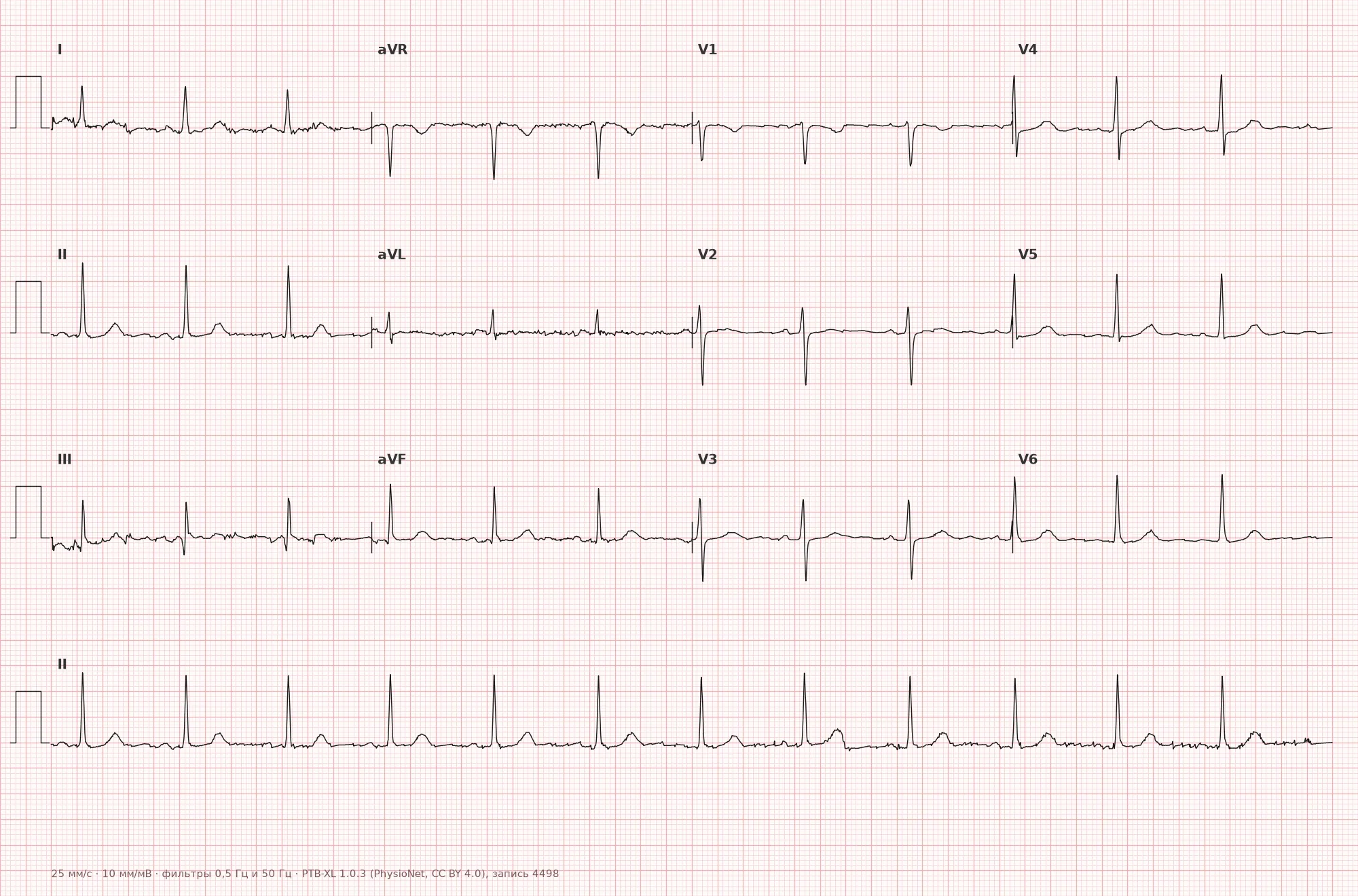 Supraventricular extrasystole on ECG — example 1, 12 leads