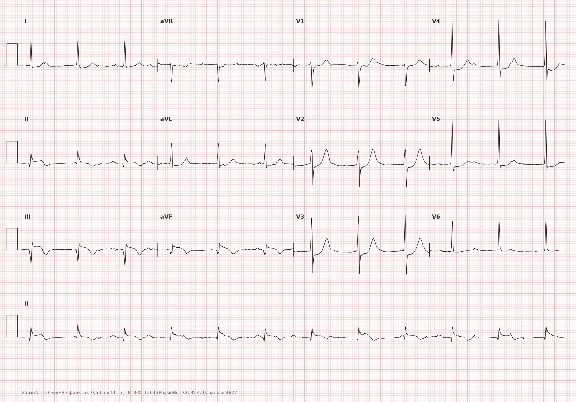 Complete AV block (third-degree) on ECG — Example 1, 12-lead