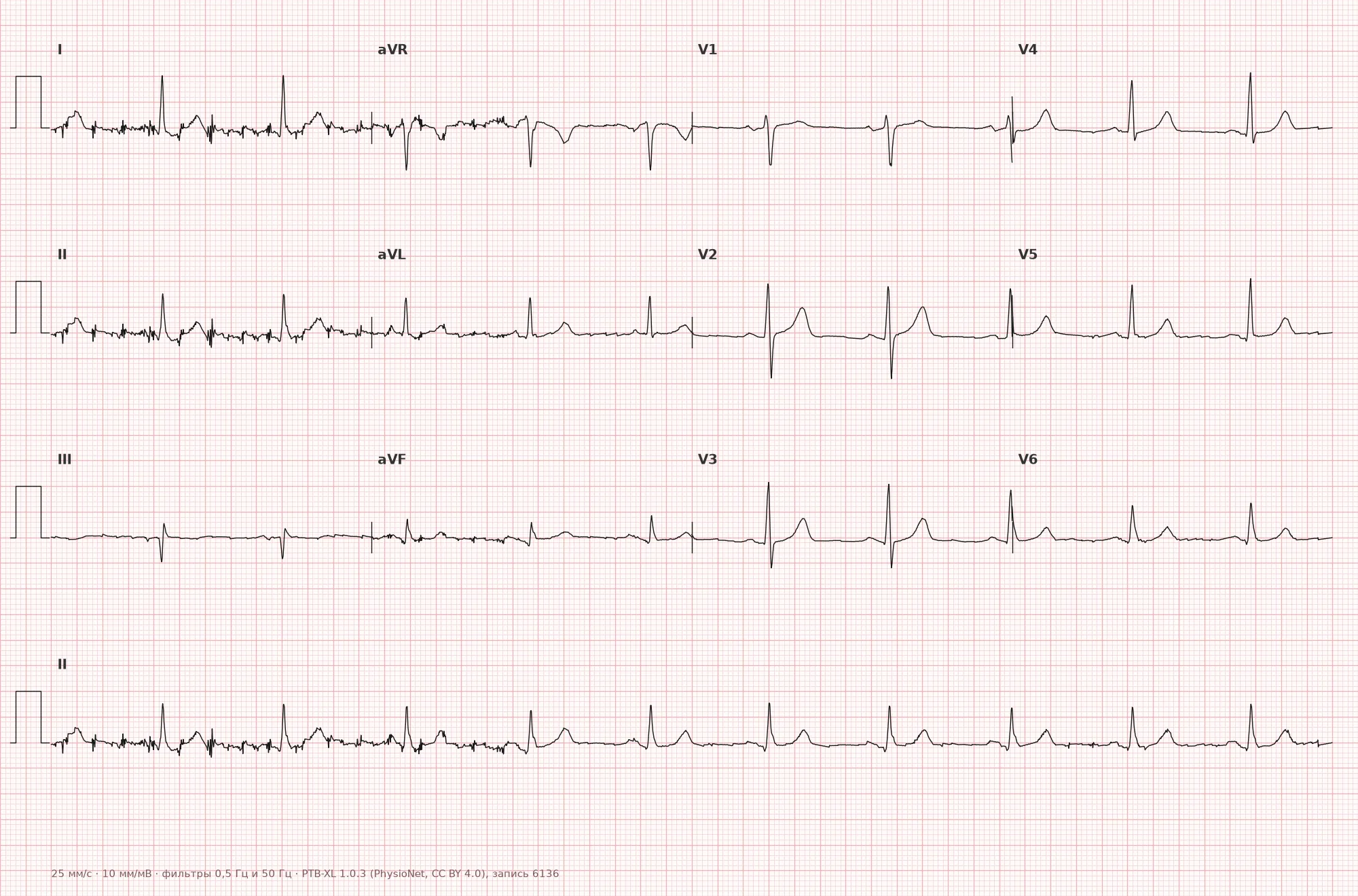 Pathological Q wave on ECG — Example 1, 12-lead