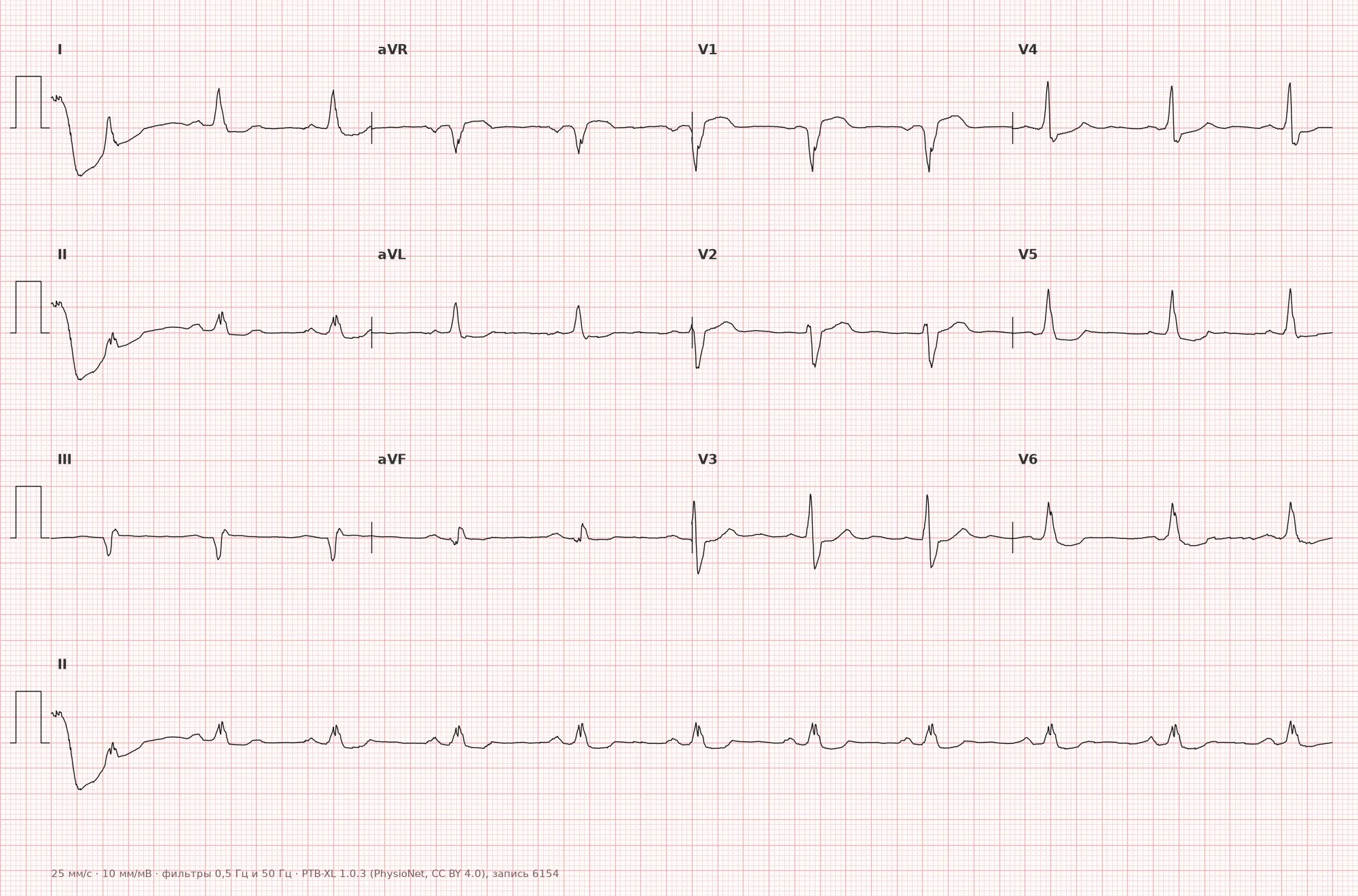 Left bundle branch block on ECG — Example 1, 12 leads