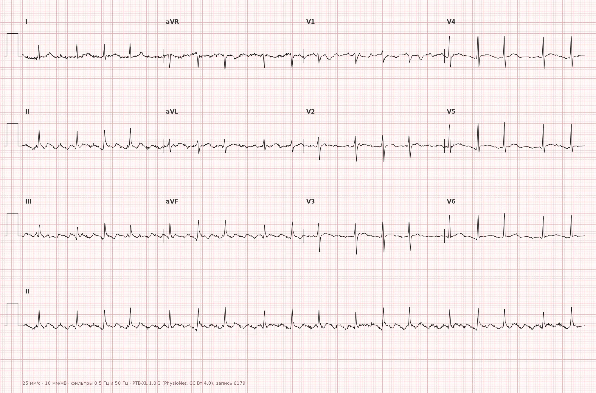Atrial flutter on ECG — Example 1, 12-lead