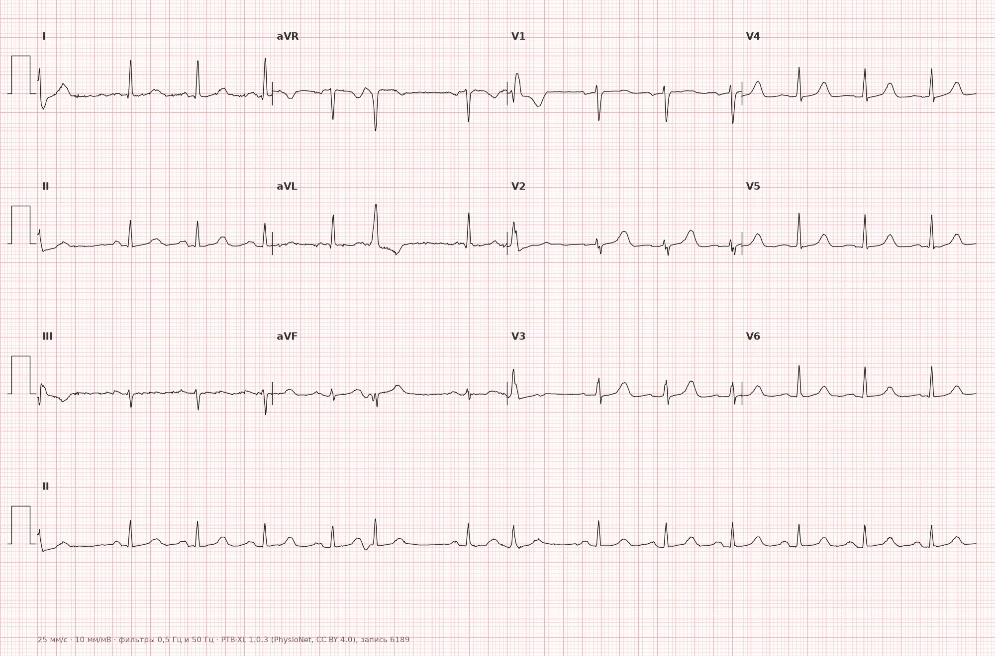 Premature ventricular contraction on ECG — Example 1, 12-lead