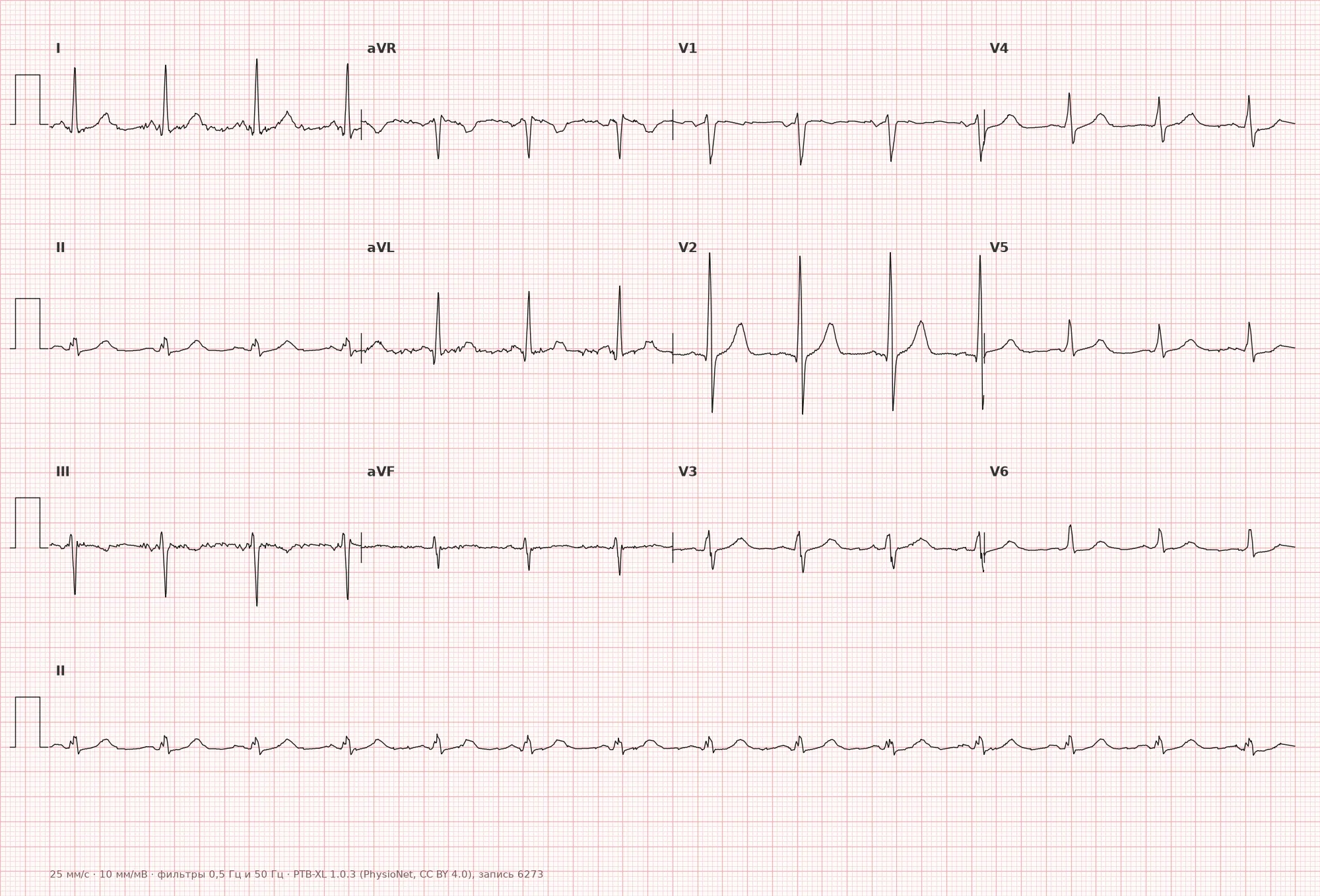 Wide QRS complex on ECG — example 1, 12-lead