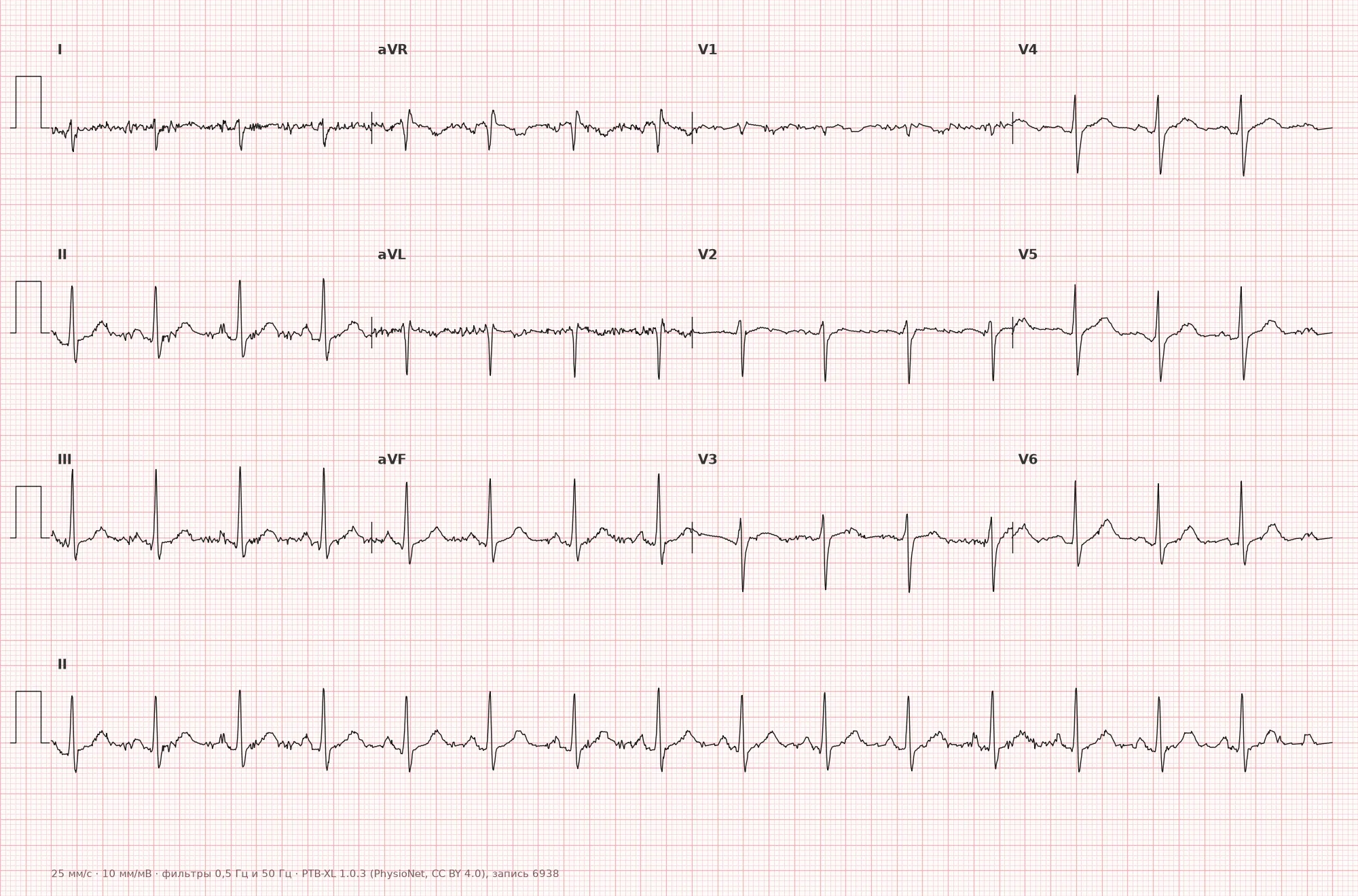 Left posterior fascicular block on ECG — Example 1, 12-lead