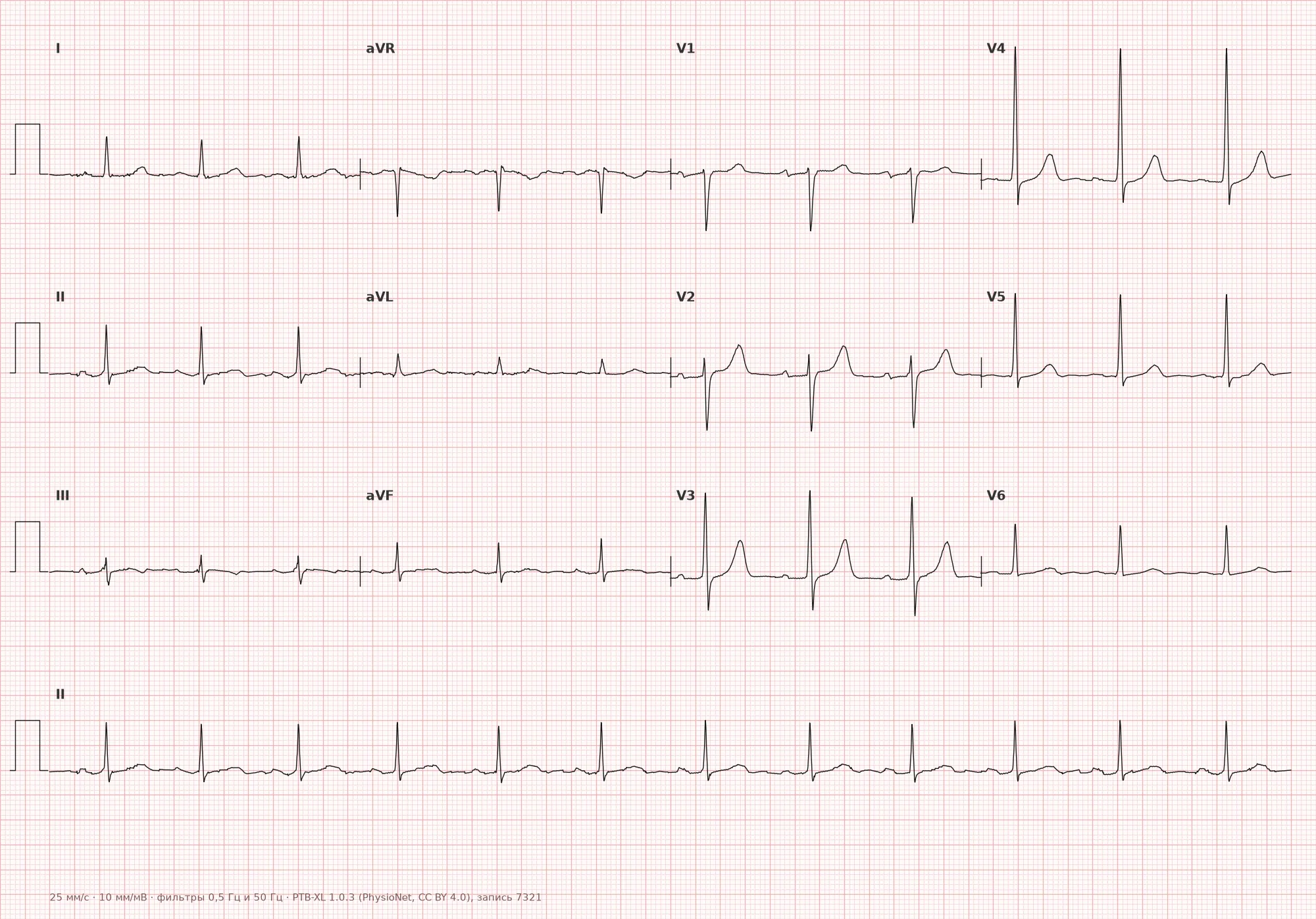 First-degree AV block on ECG — Example 1, 12-lead