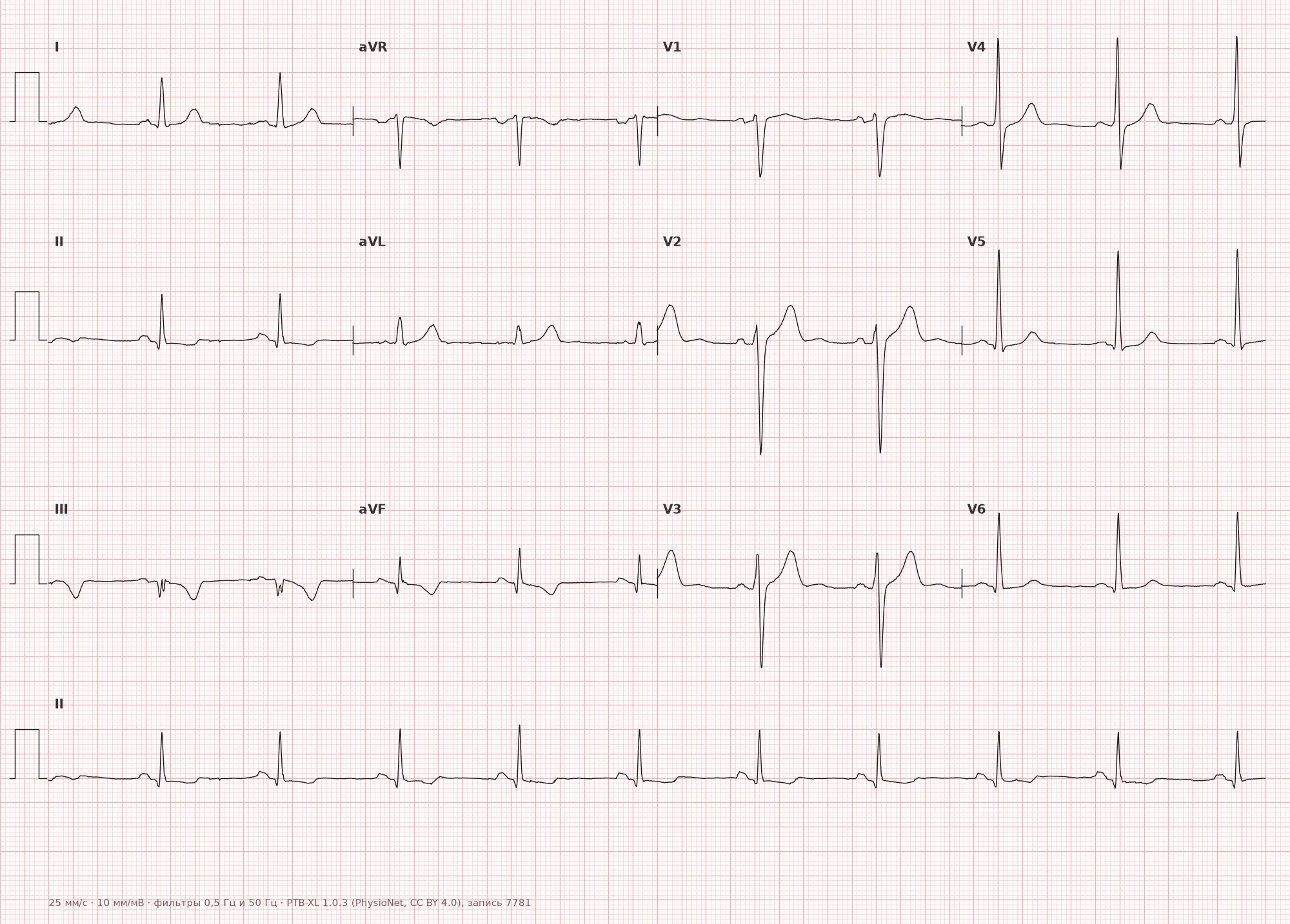 Inferior myocardial infarction on ECG — Example 1, 12 leads