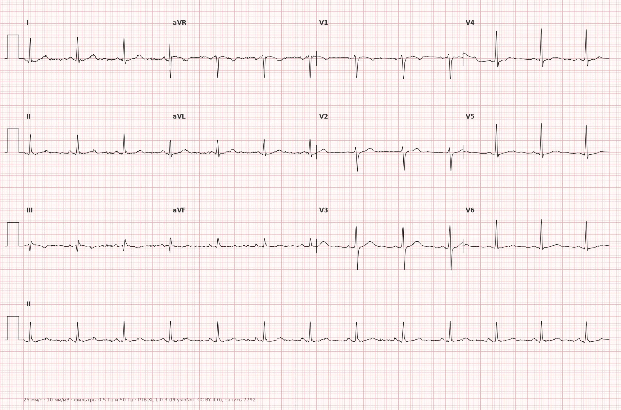 Nonspecific ST-T changes on ECG — Example 1, 12 leads