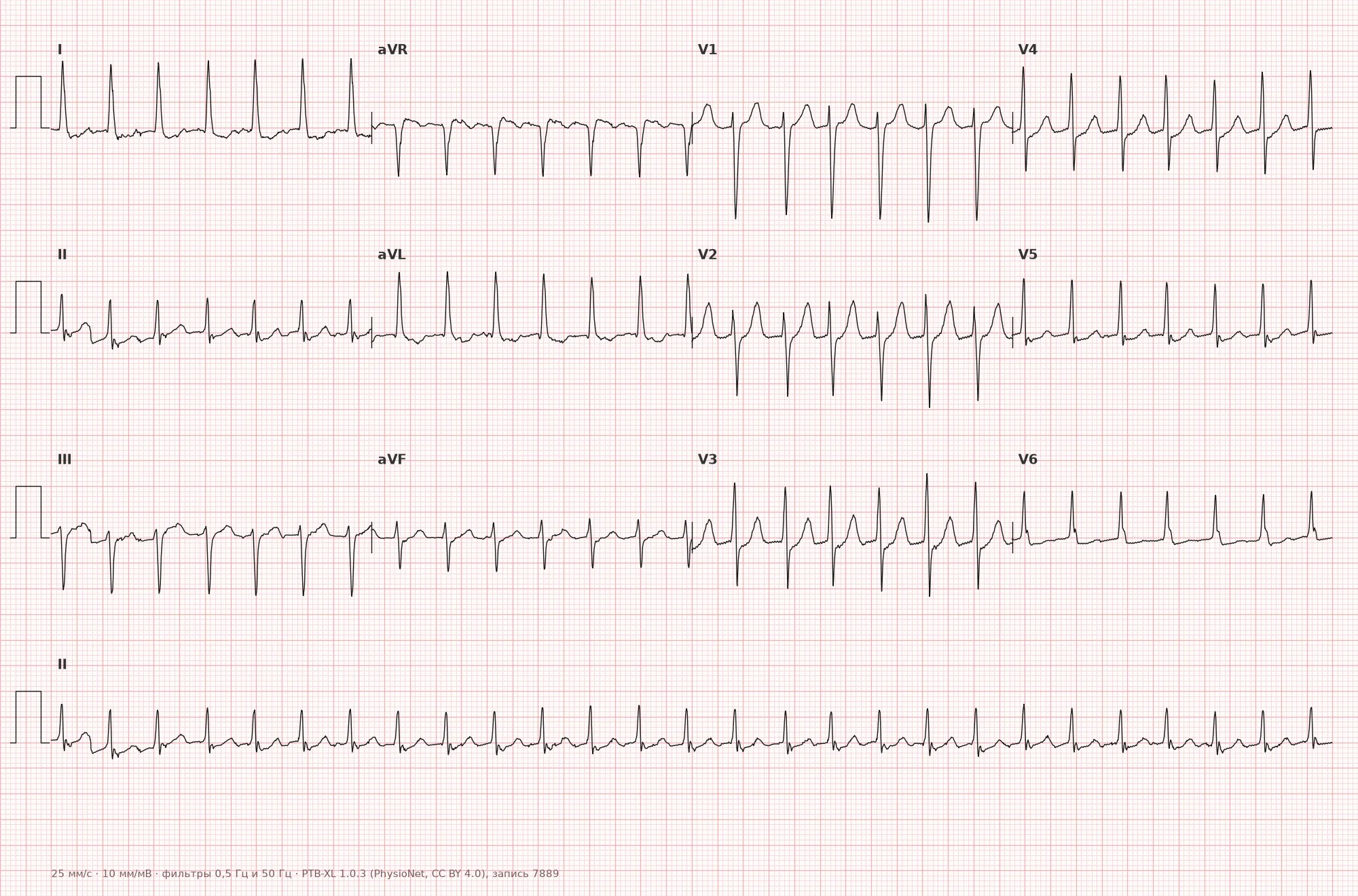 Paroxysmal supraventricular tachycardia on ECG — Example 1, 12-lead