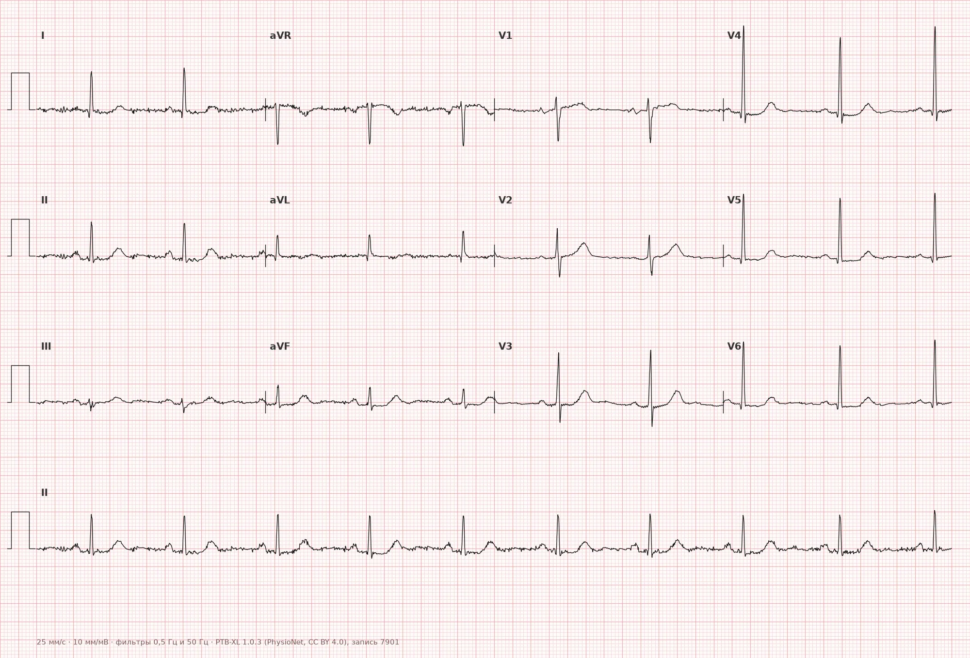 ST-segment depression on ECG — Example 1, 12-lead