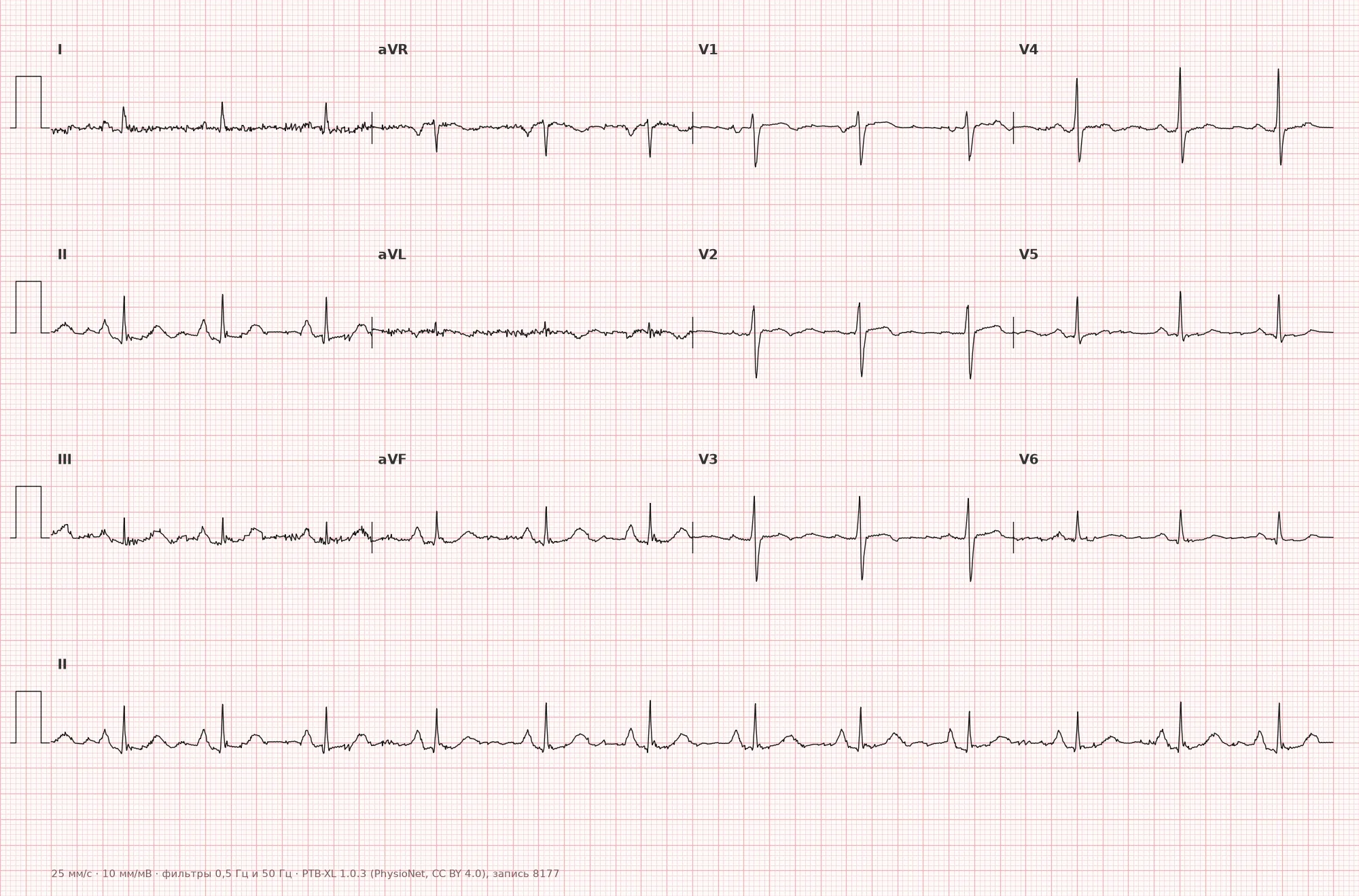 Right atrial enlargement on ECG — example 1, 12-lead